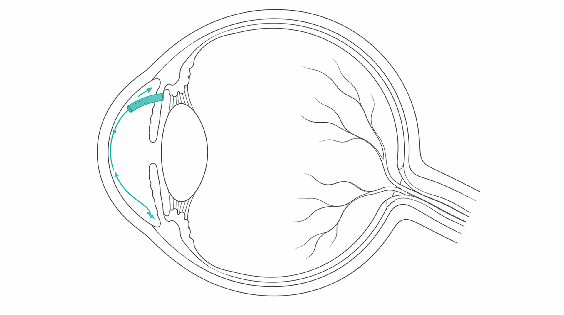 Medical line illustration of glaucoma eye pressure surgery for Glaucoma surgery (trabeculectomy).
