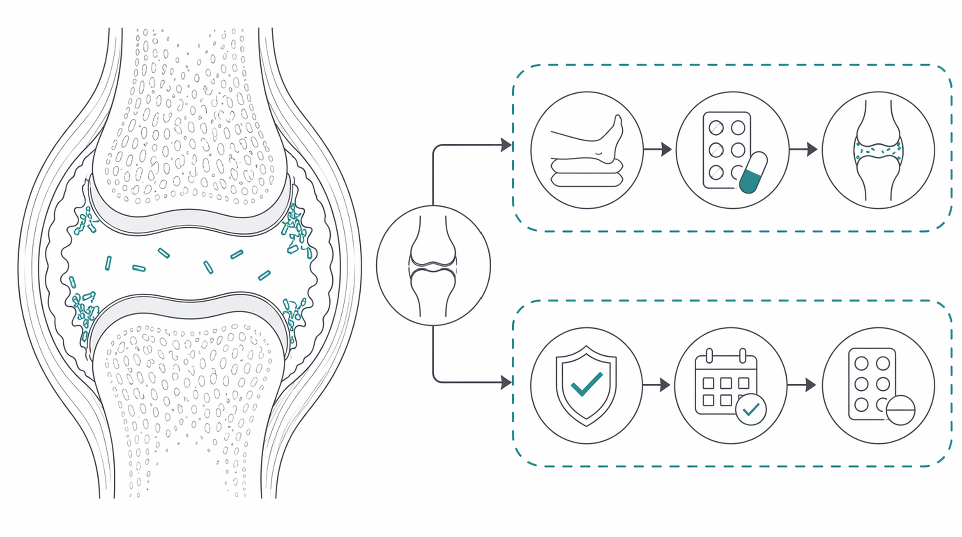 Medical line illustration of gout crystal arthritis for Gout treatment.