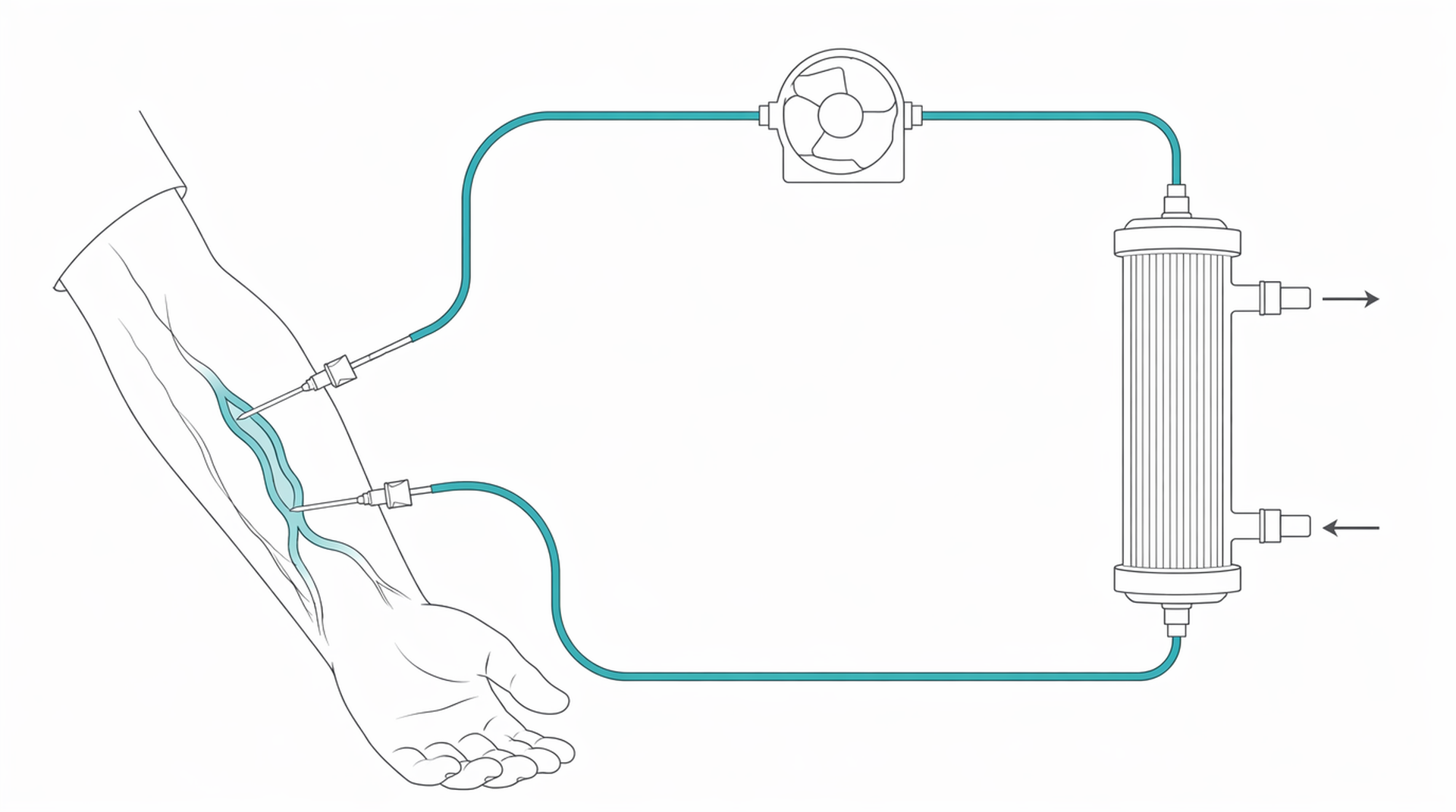 Medical line illustration of haemodialysis circuit arm fistula for Holiday dialysis.