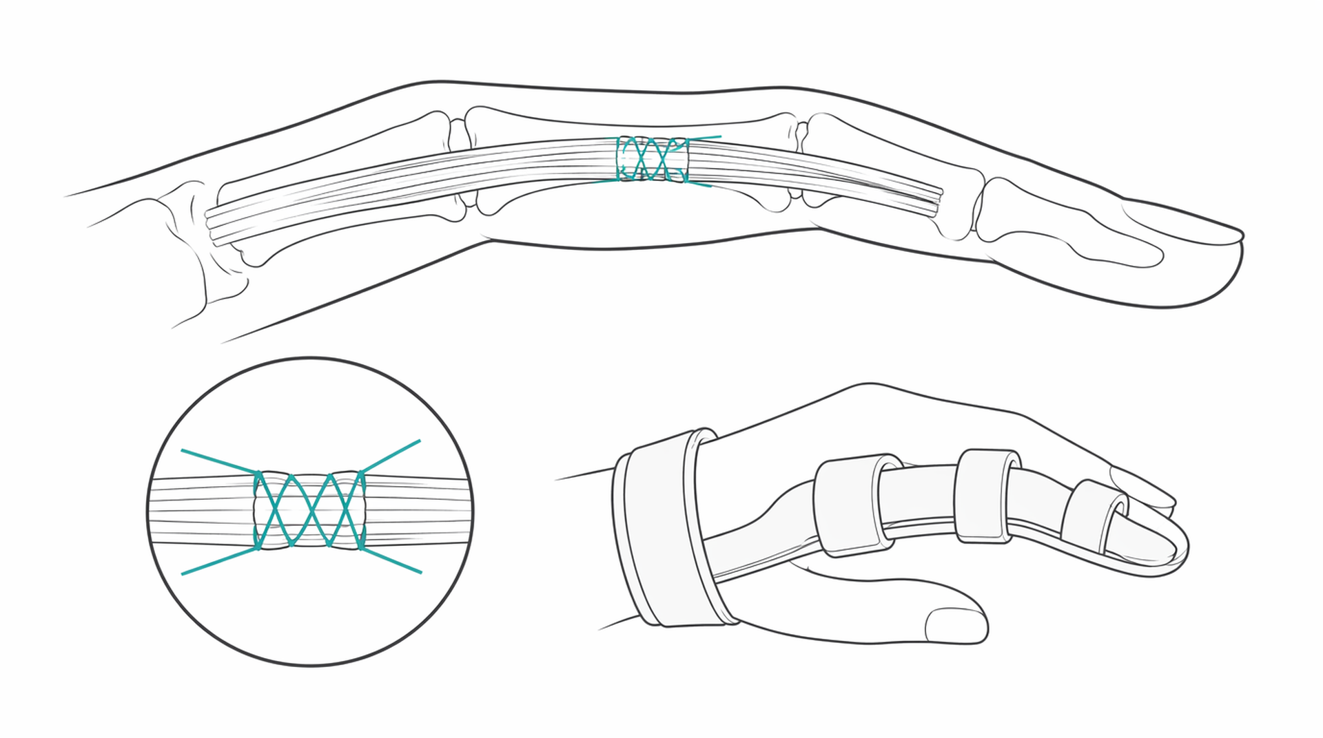 Medical line illustration of hand tendon repair for Hand surgery.