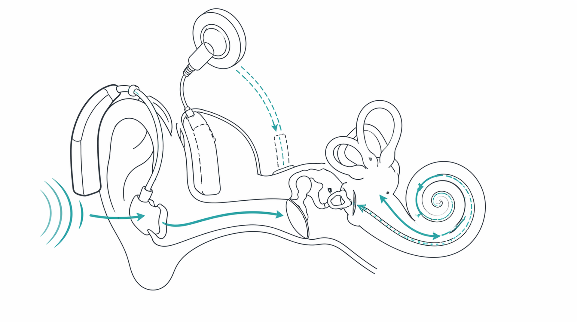 Medical line illustration of hearing aid cochlear implant for Cochlear implant.