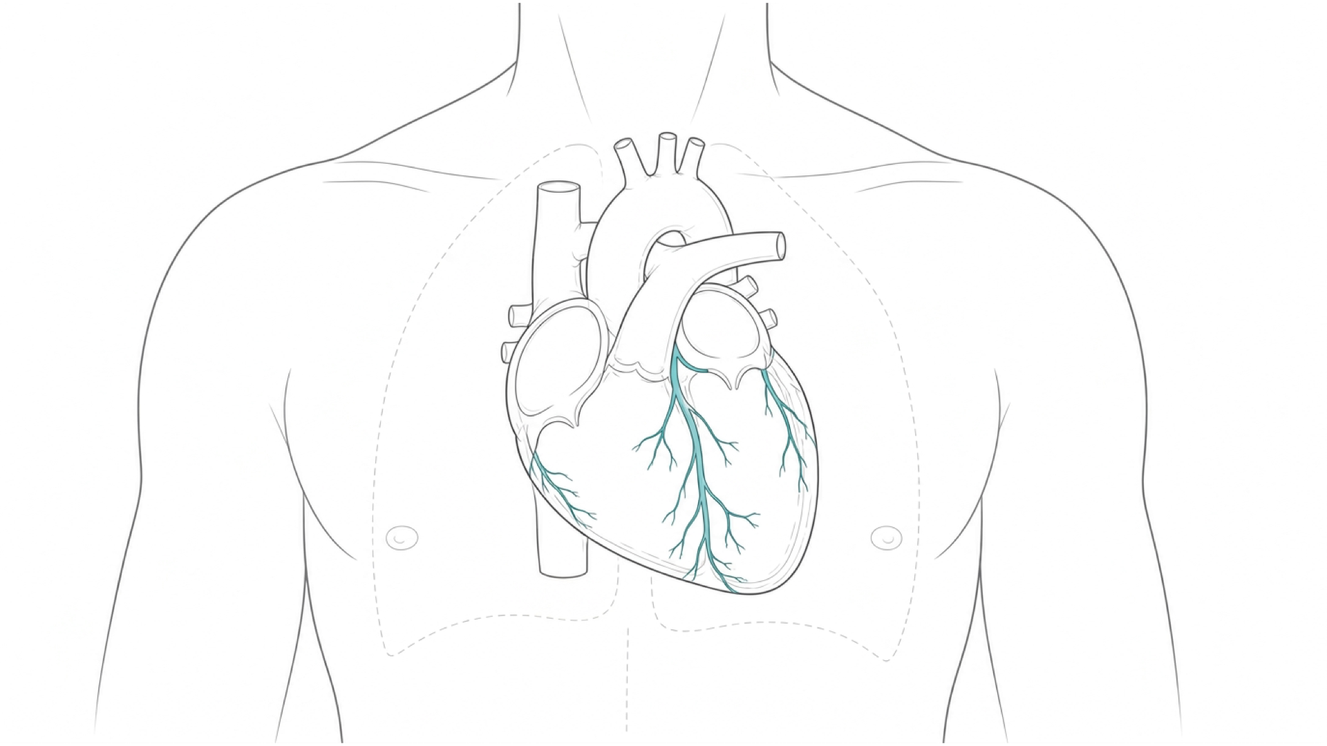 Medical line illustration of the heart and coronary circulation for Thymus removal.