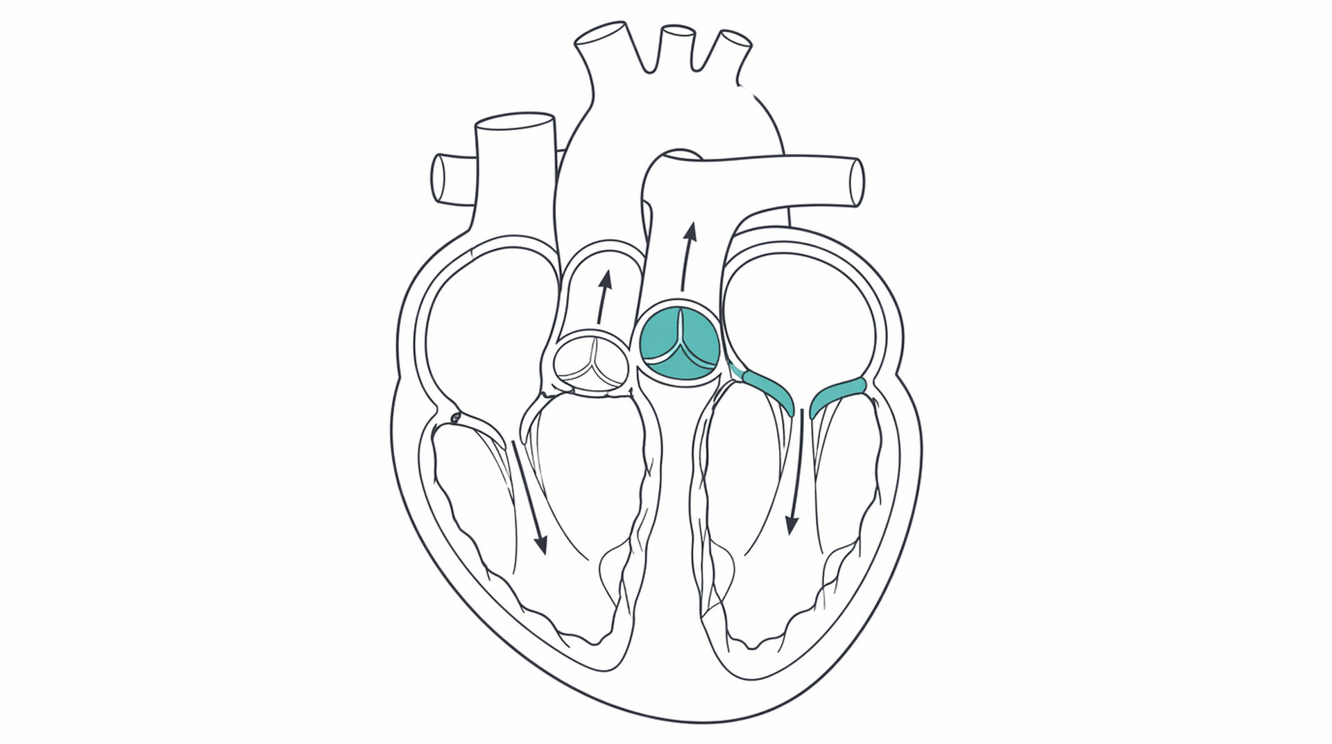 Medical line illustration of heart valve anatomy for Heart valve surgery.