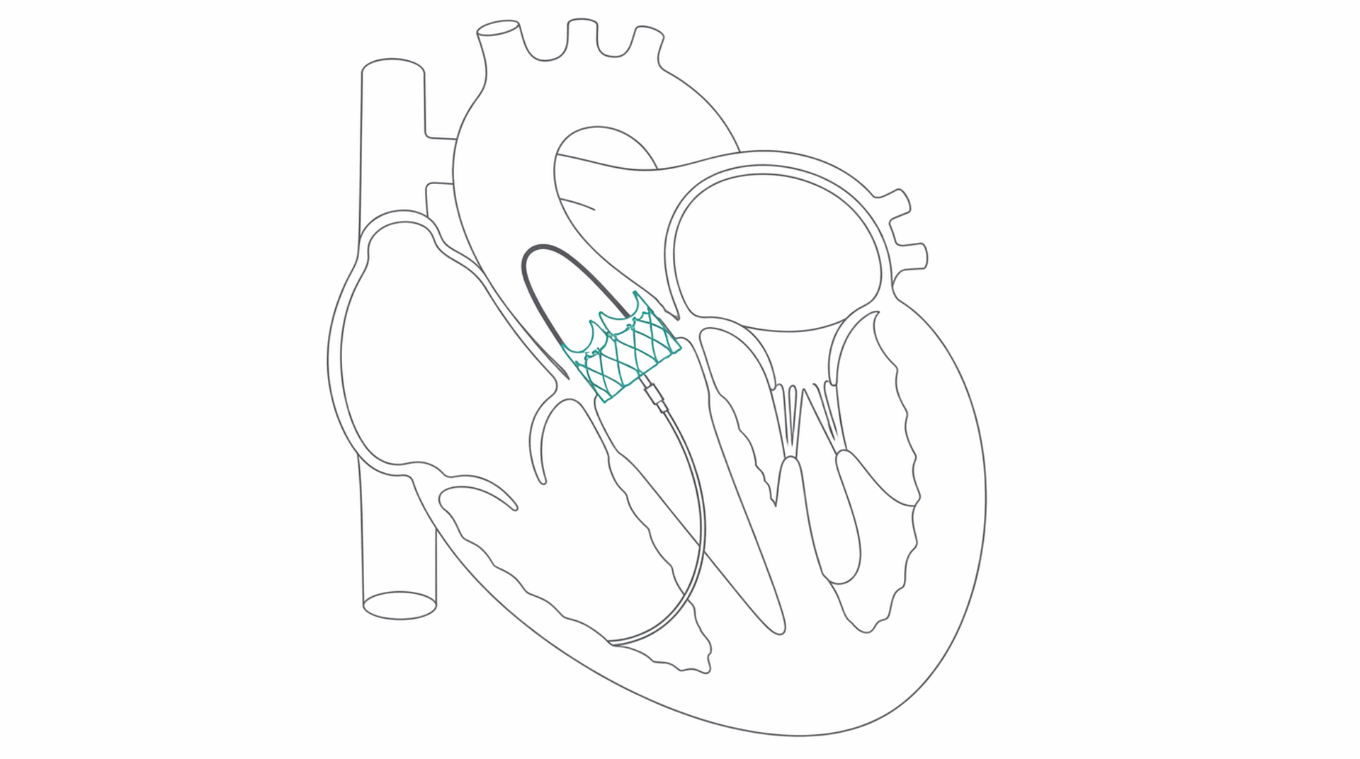 Medical line illustration of heart valve structural heart for Aortic valve replacement.