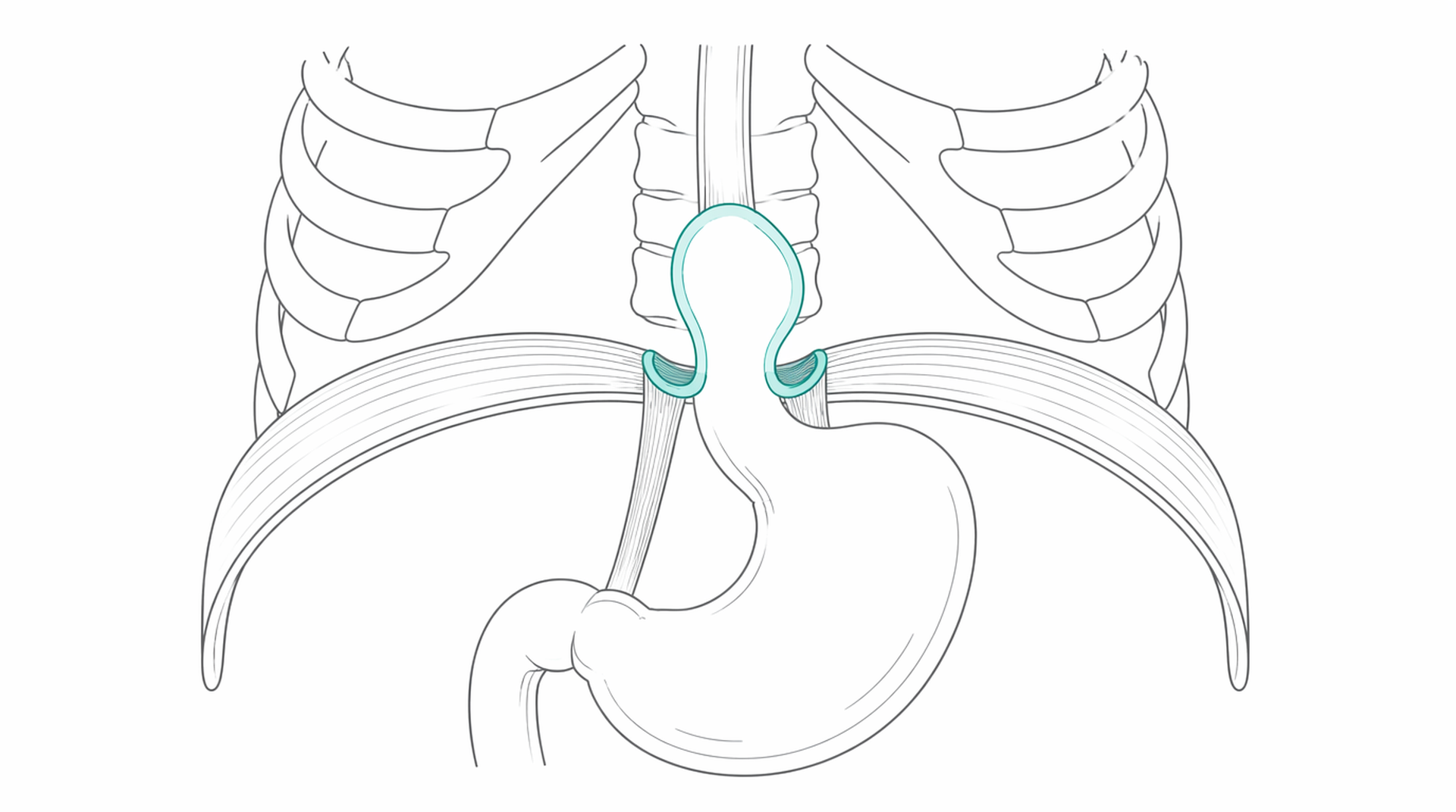 Medical line illustration of hiatus hernia diaphragm for LINX reflux management.