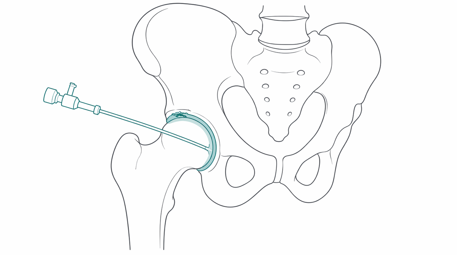 Medical line illustration of hip arthroscopy groin for Hip and groin pain assessment.
