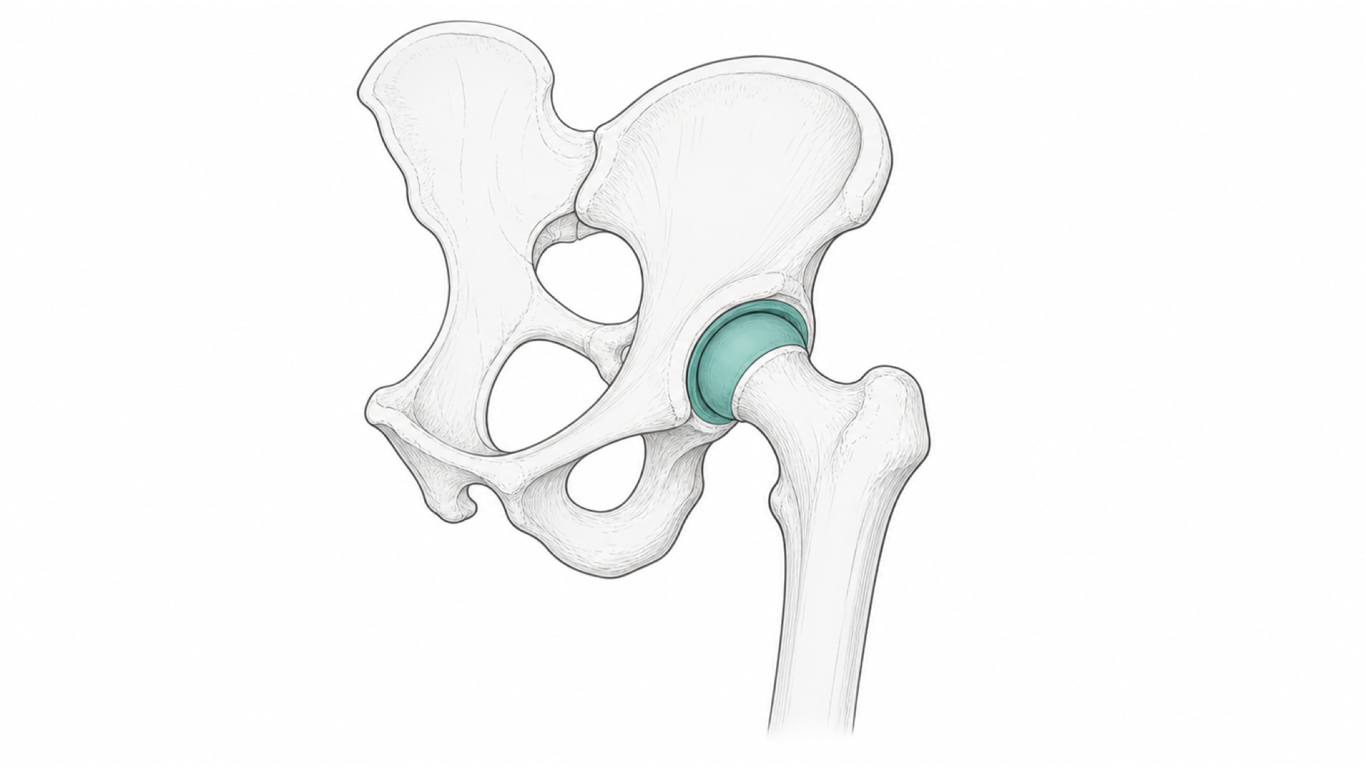 Medical line illustration of the hip and pelvis joint for Hip replacement.