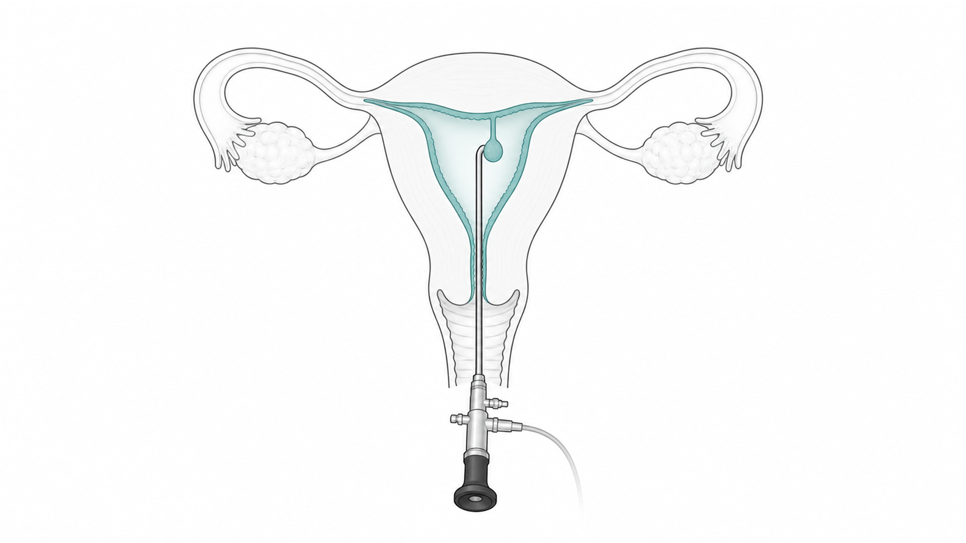 Medical line illustration of the uterus and hysteroscopy pathway for Hysteroscopy.