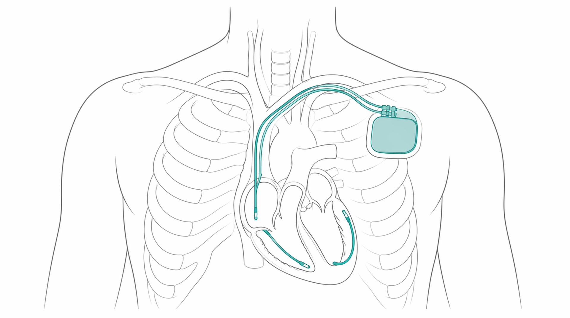 Medical line illustration of implanted cardiac rhythm device for Defibrillator (ICD) fitting.