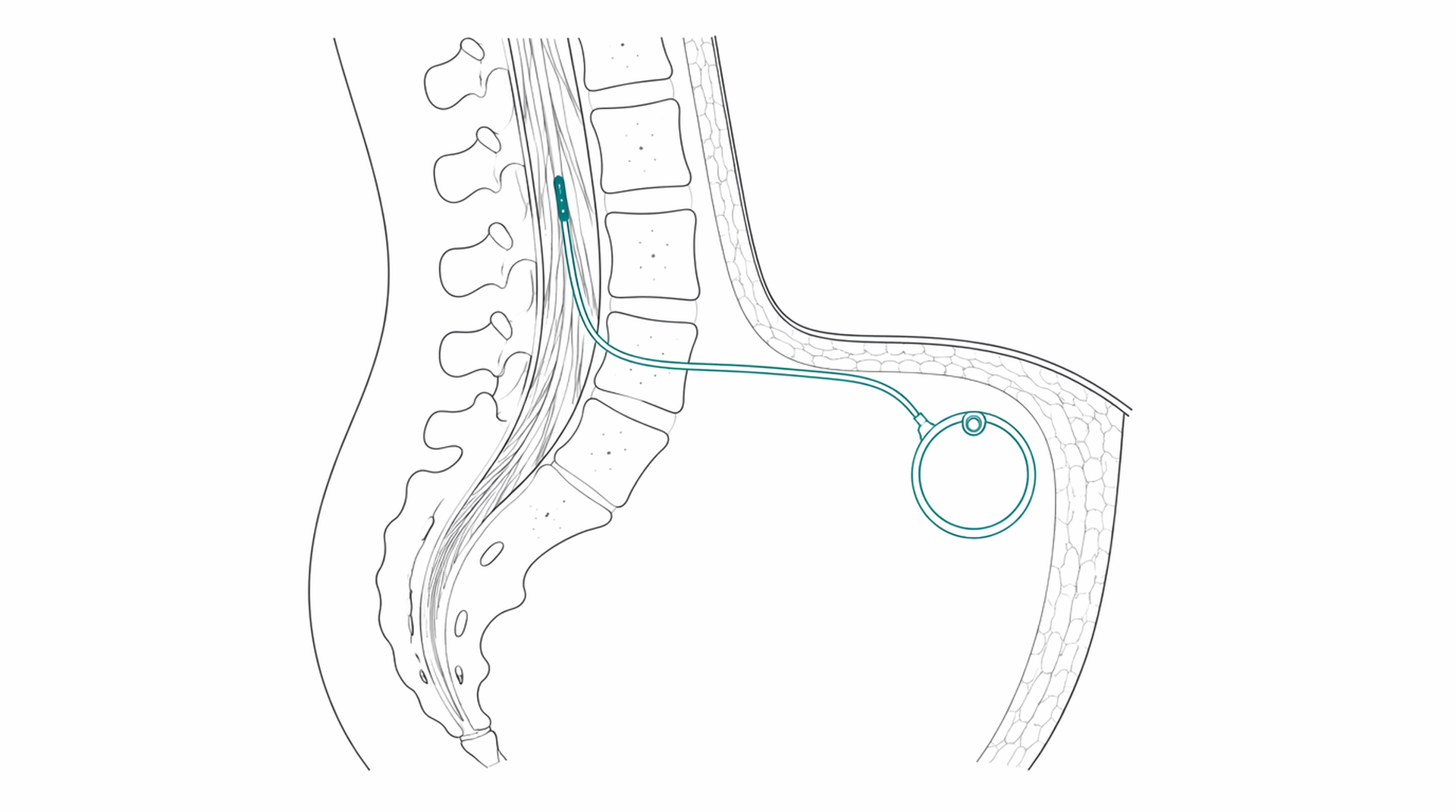 Medical line illustration of implanted spinal drug stimulation device for Intrathecal drug delivery (pain pump).