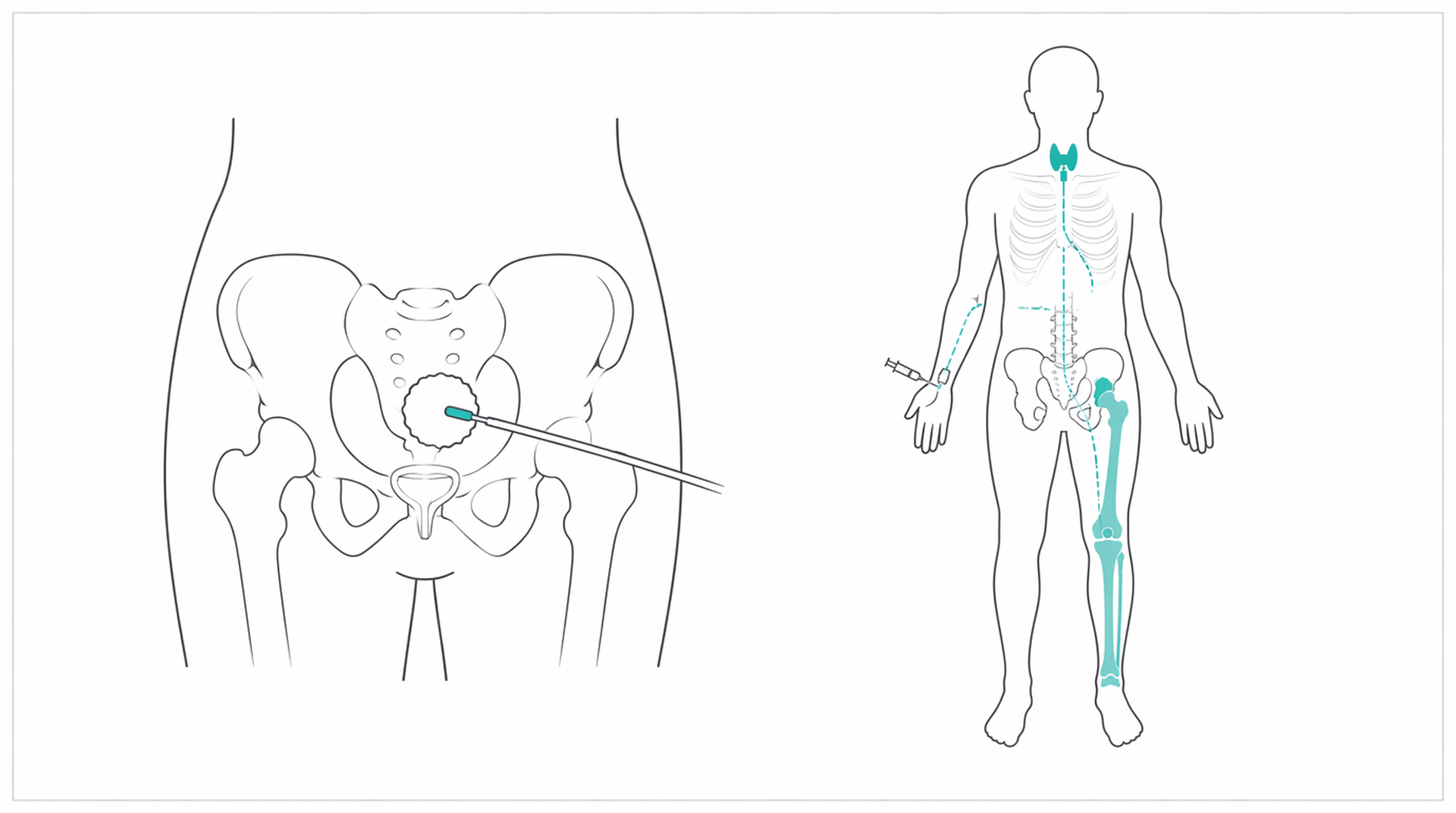 Medical line illustration of internal radiotherapy source placement for Brachytherapy (internal radiotherapy).