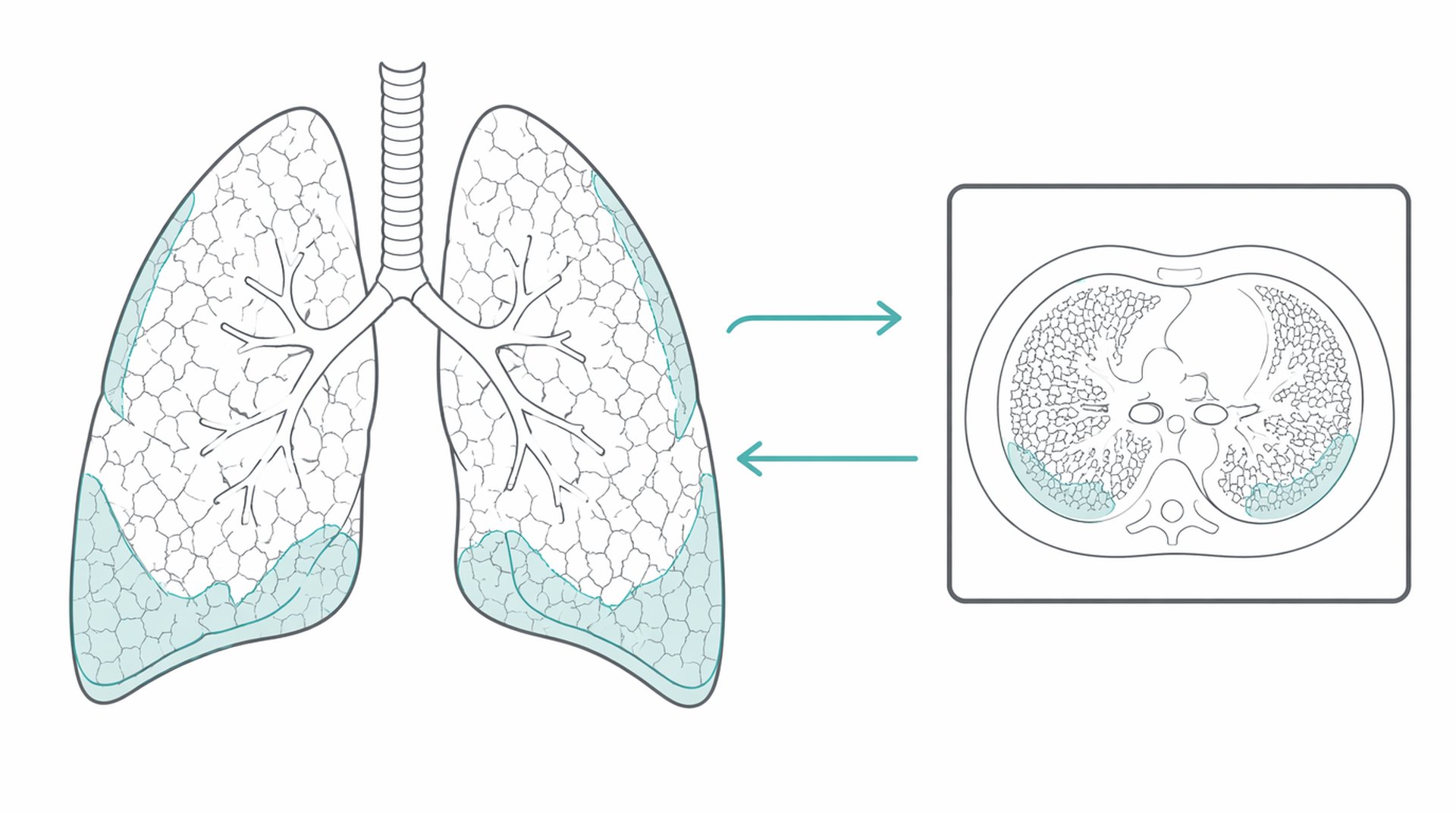 Medical line illustration of interstitial lung disease ct for Interstitial lung disease assessment.