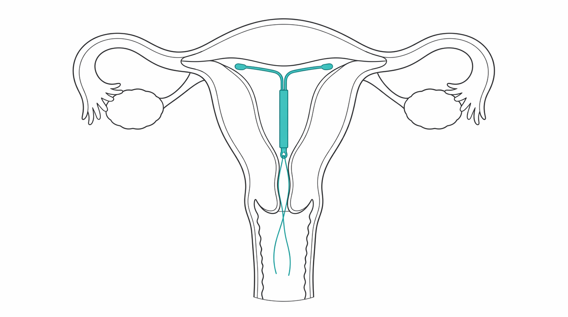 Medical line illustration of intrauterine device in uterus for Heavy periods (heavy menstrual bleeding) treatment.