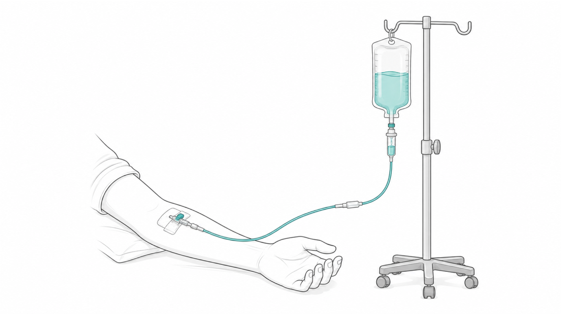 Medical line illustration of an intravenous infusion setup for Plasma exchange (plasmapheresis).