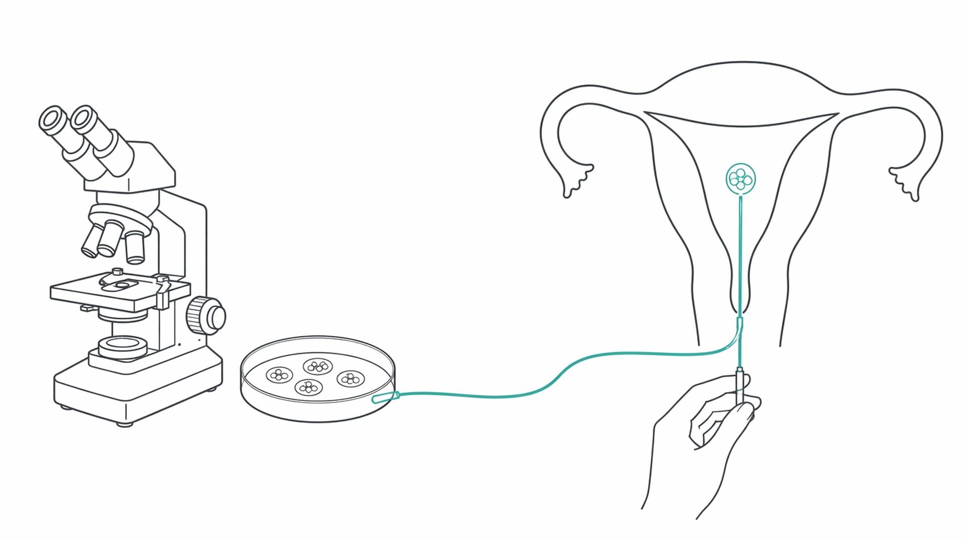 Medical line illustration of ivf embryo transfer for IVF.