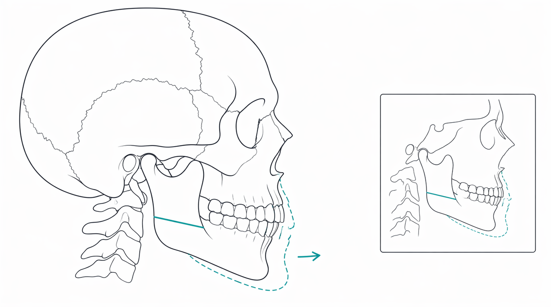 Medical line illustration of jaw realignment osteotomy for Jaw realignment surgery (orthognathic surgery).