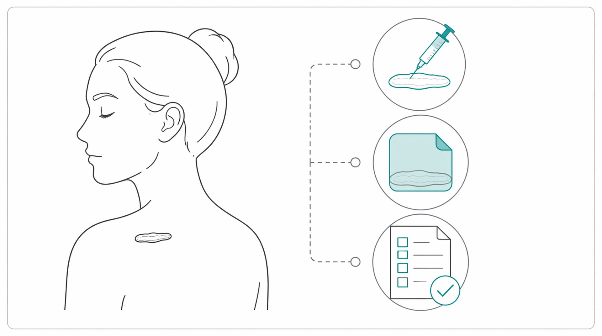 Medical line illustration of keloid scar treatment for Scar revision.
