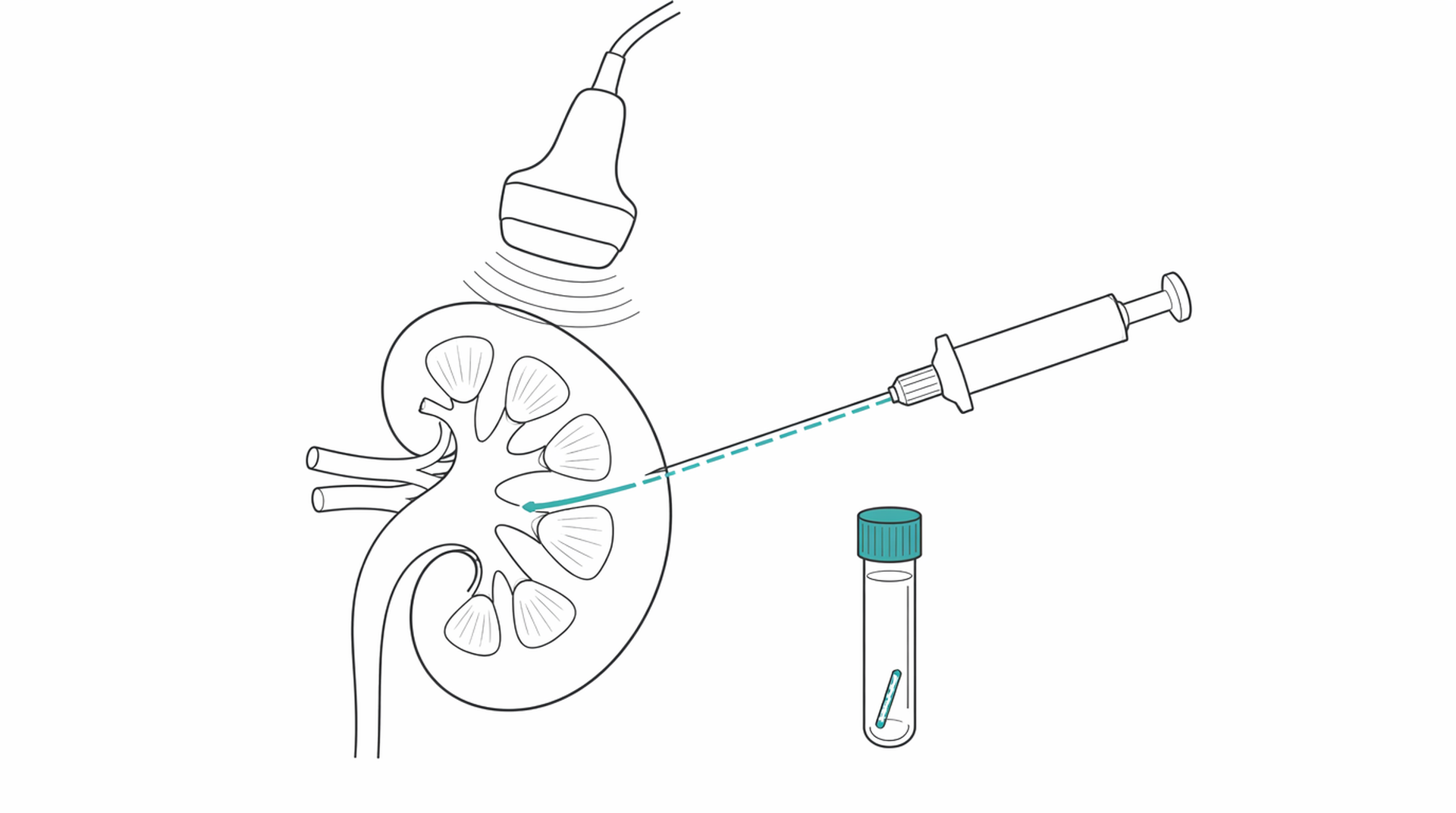 Medical line illustration of kidney biopsy nephrology for Kidney biopsy.
