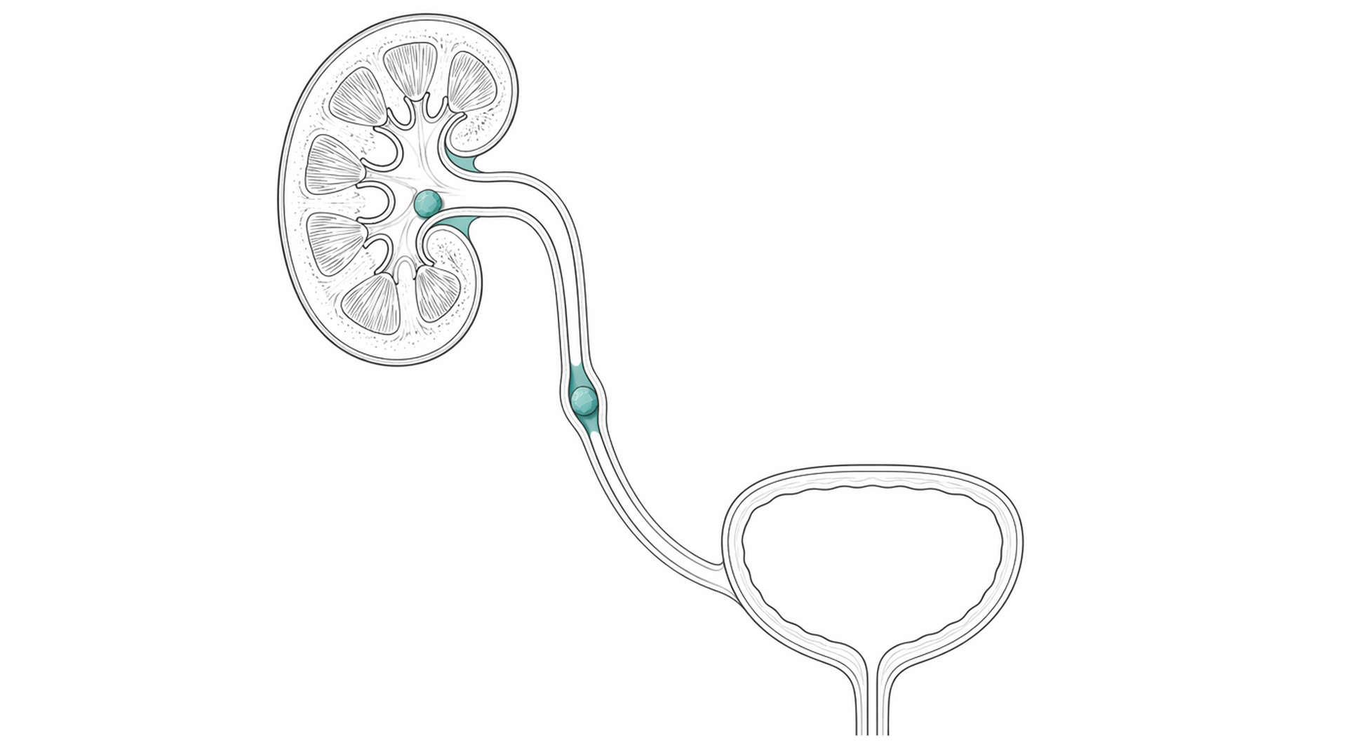 Medical line illustration of kidney stone in the urinary tract for Nephrostomy (kidney drainage).