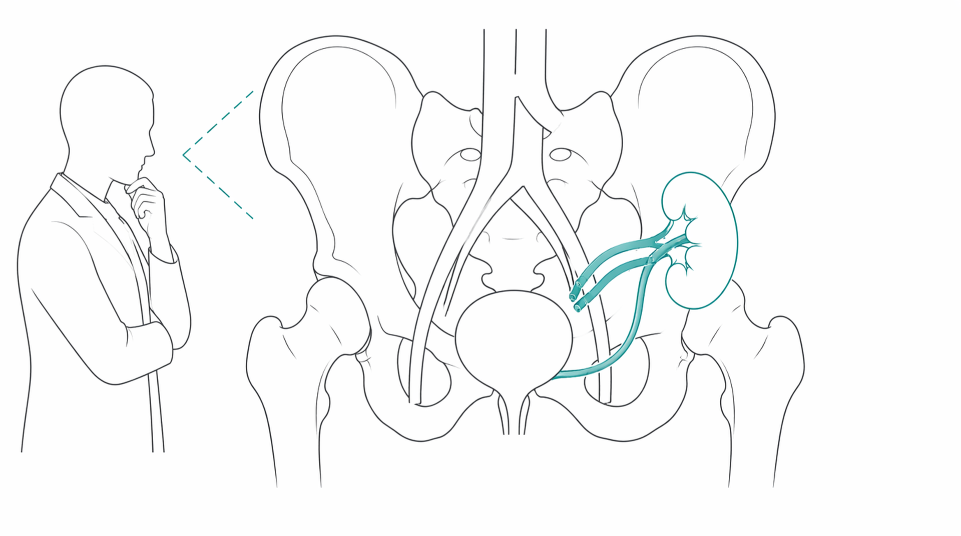 Medical line illustration of kidney transplant assessment for Kidney transplant assessment.