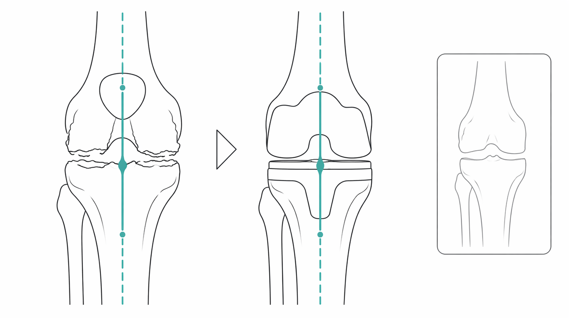 Medical line illustration of knee replacement implant for Knee replacement.