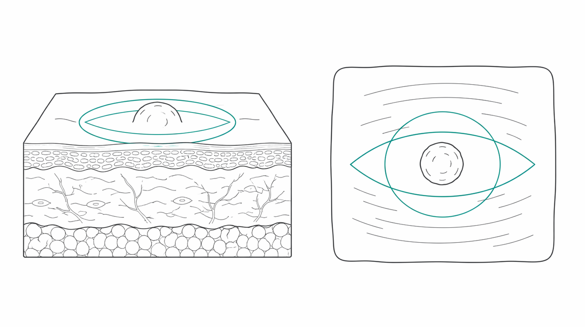 Medical line illustration of lesion excision with margin for Excised lesion and specimen analysis.