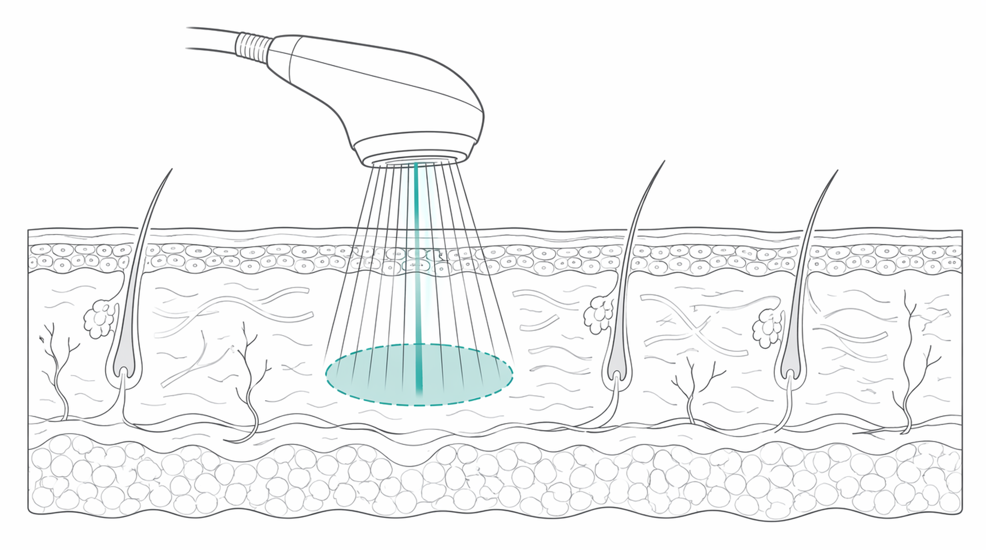 Medical line illustration of light and energy skin treatment for Phototherapy (UVB) treatment.
