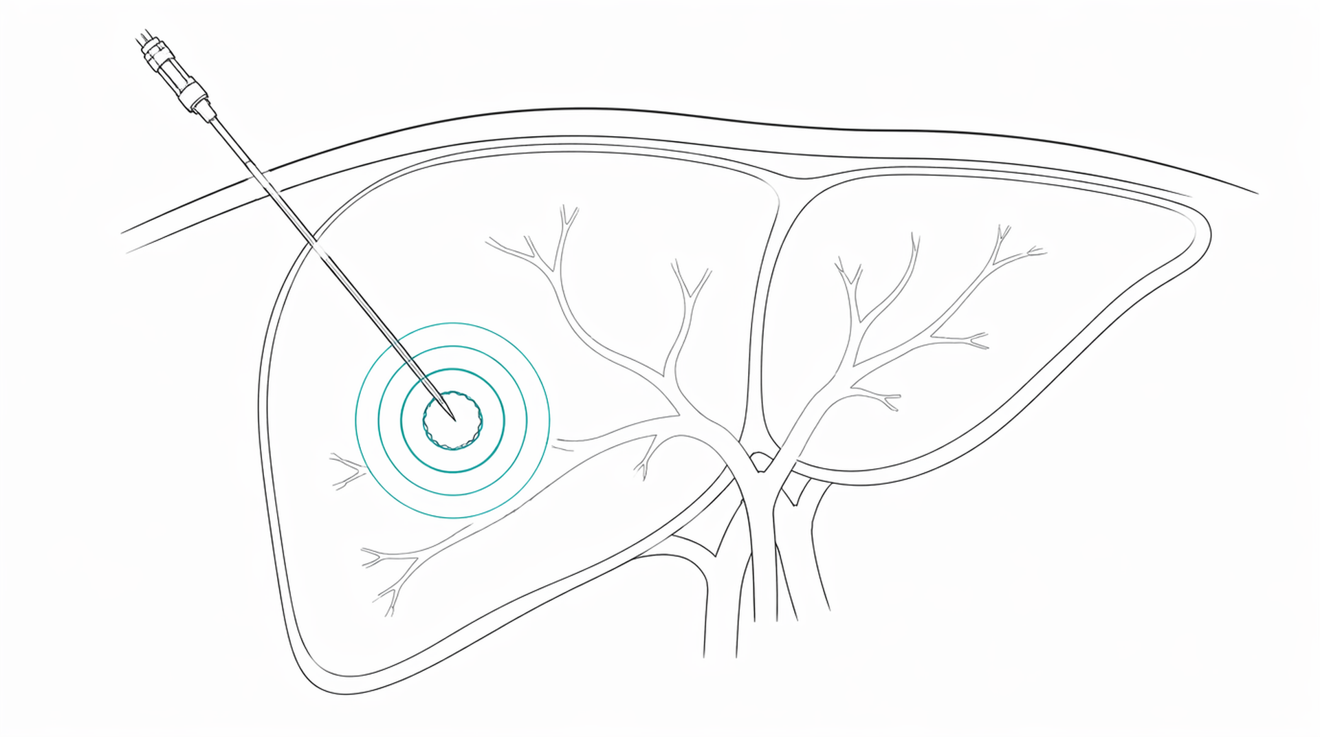 Medical line illustration of liver tumour ablation for Laparoscopic (keyhole) liver surgery.