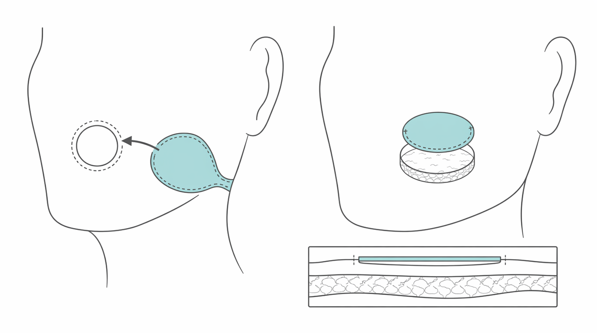 Medical line illustration of local flap and skin graft repair for Facial reconstruction.