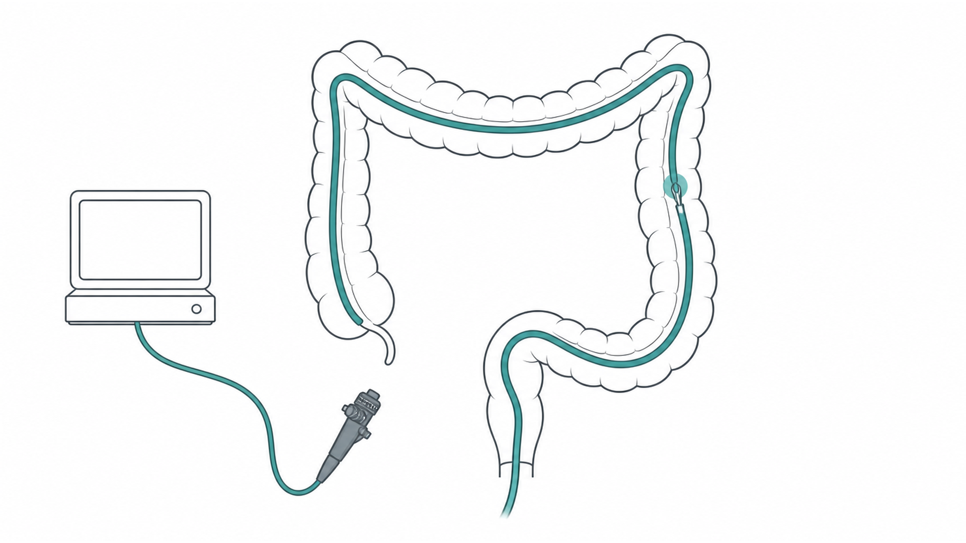 Medical line illustration of the large bowel and colonoscopy pathway for Colonoscopy.