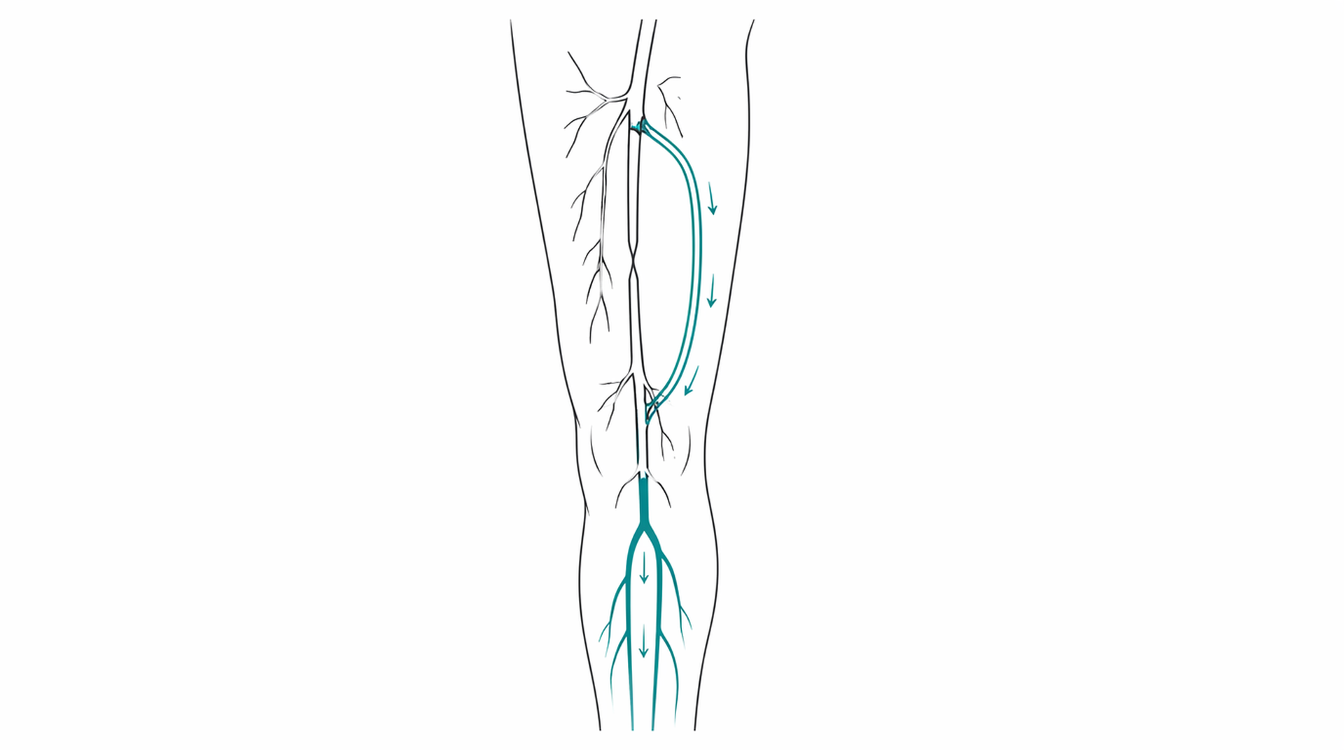 Medical line illustration of lower limb arterial supply and bypass for Lower limb bypass surgery.