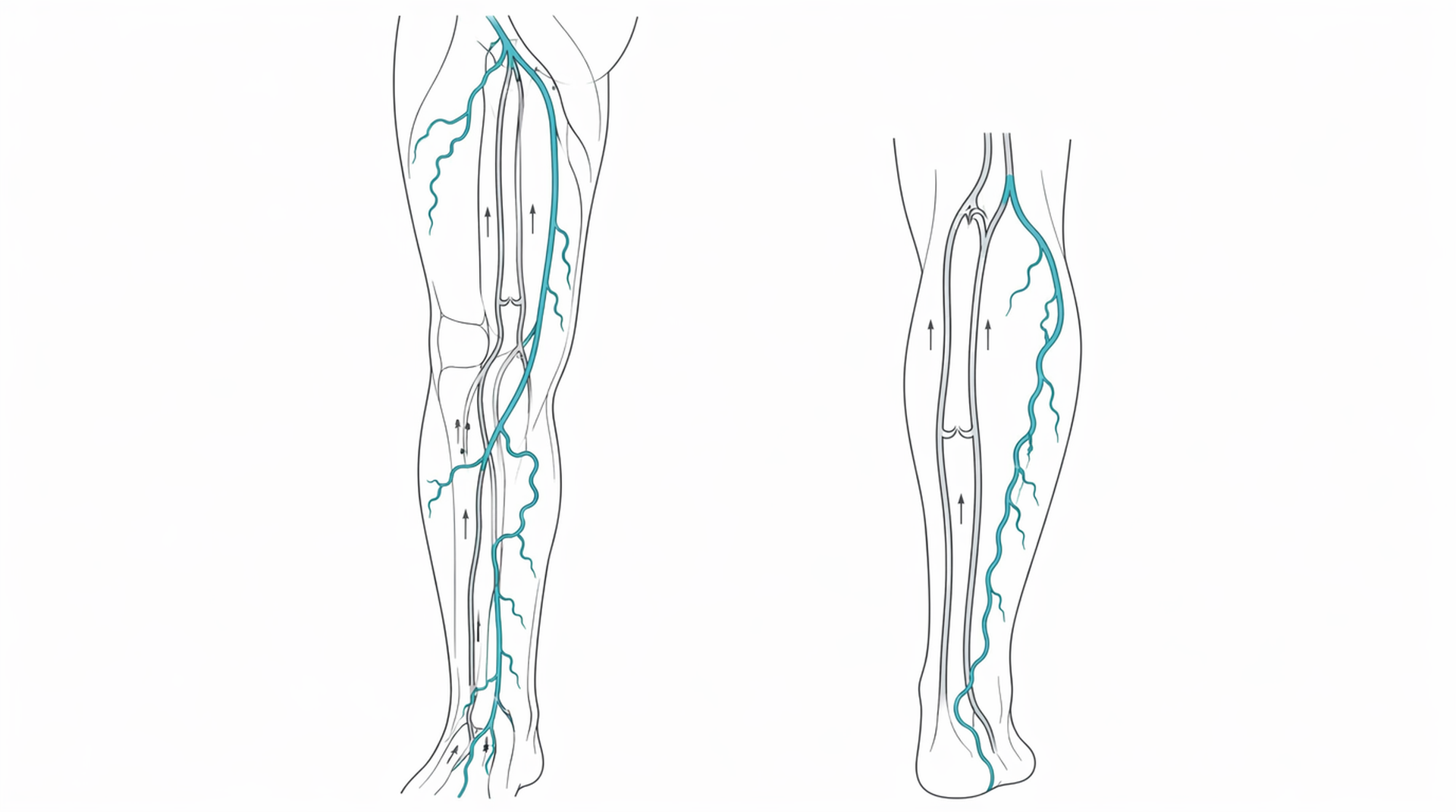 Medical line illustration of lower limb venous system for DVT treatment.