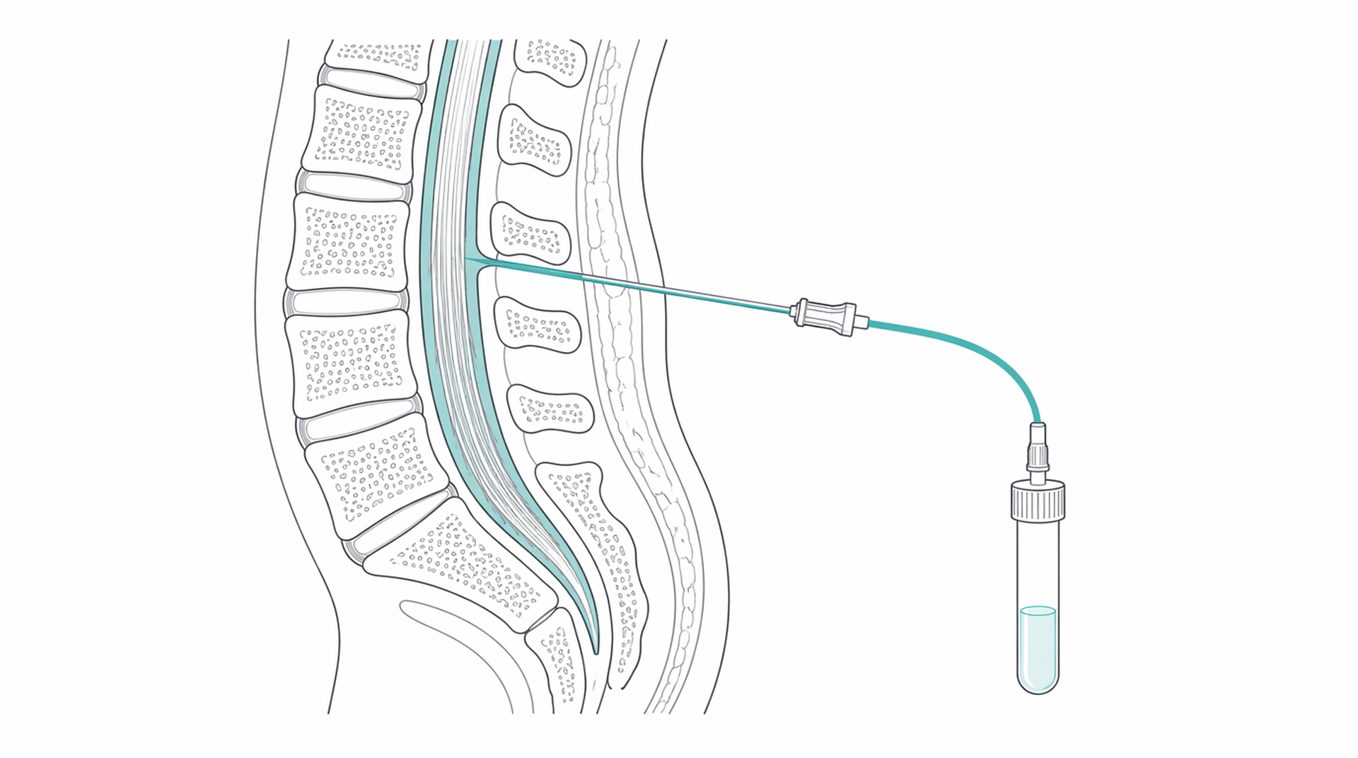 Medical line illustration of lumbar puncture csf test for Lumbar puncture.