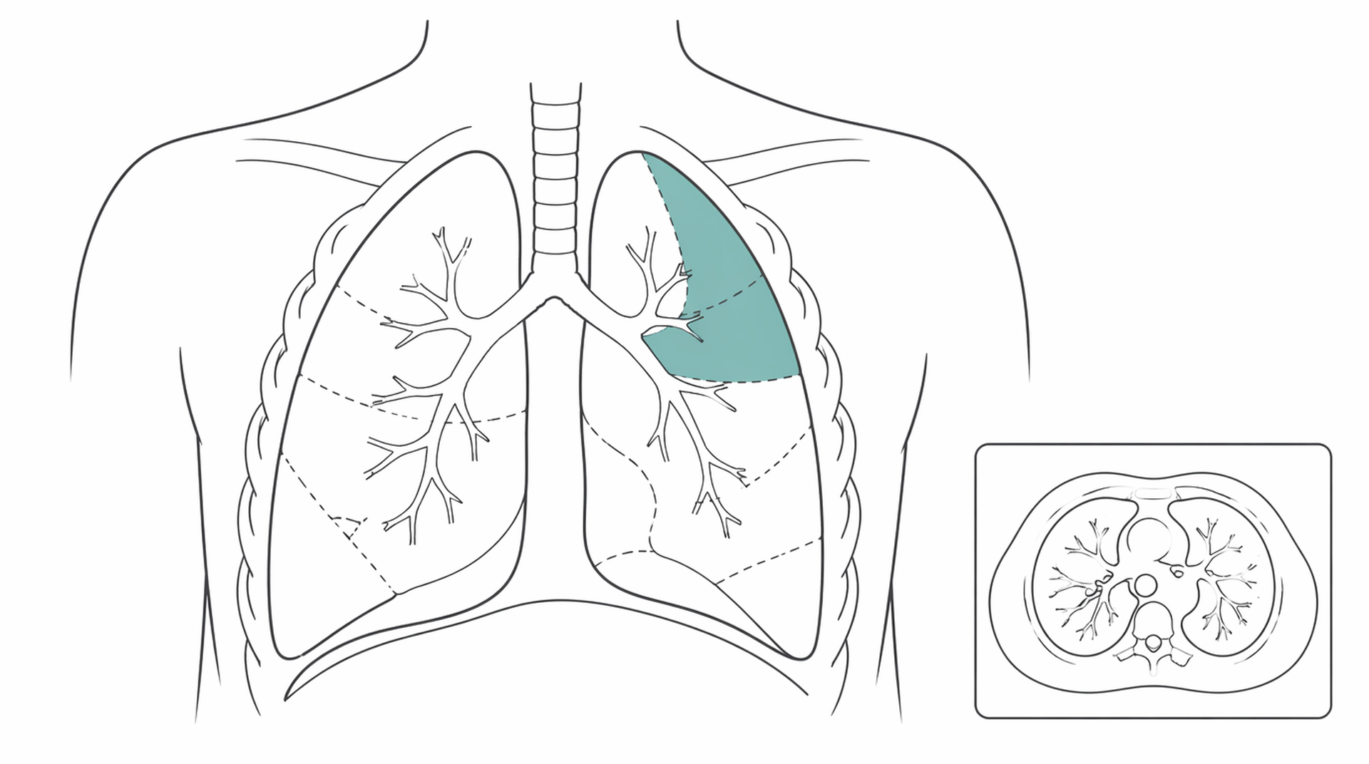 Medical line illustration of lung cancer surgery for Keyhole lung surgery (VATS).