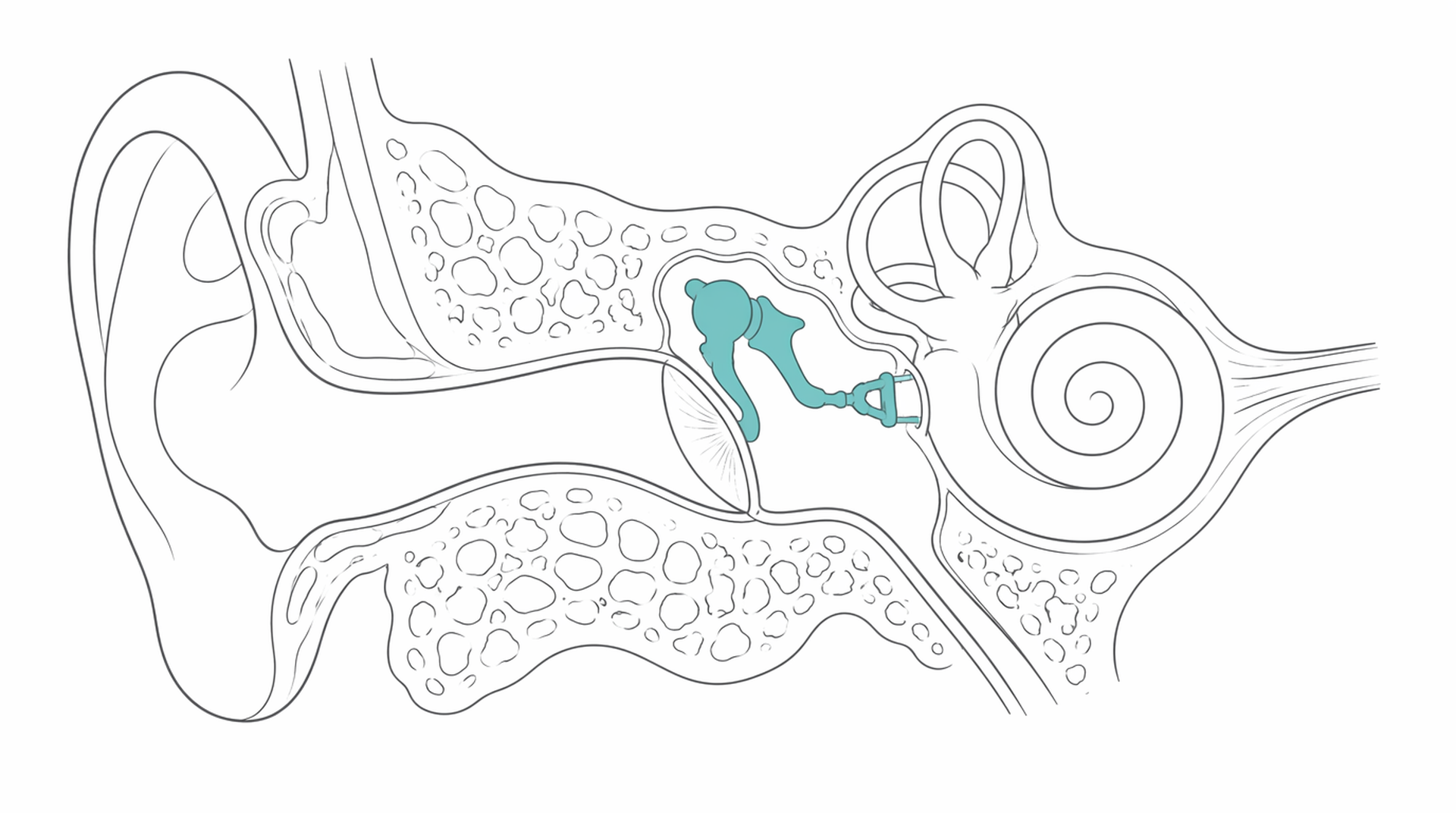 Medical line illustration of middle ear ossicle mastoid surgery for Mastoid surgery.