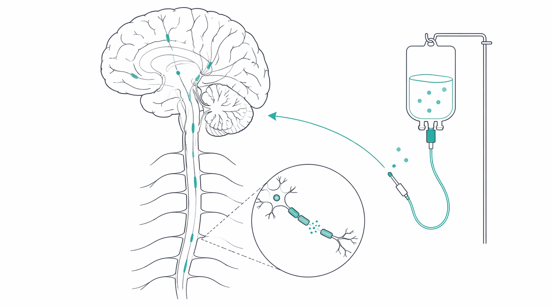 Medical line illustration of ms demyelination therapy for Disease-modifying therapy for MS.