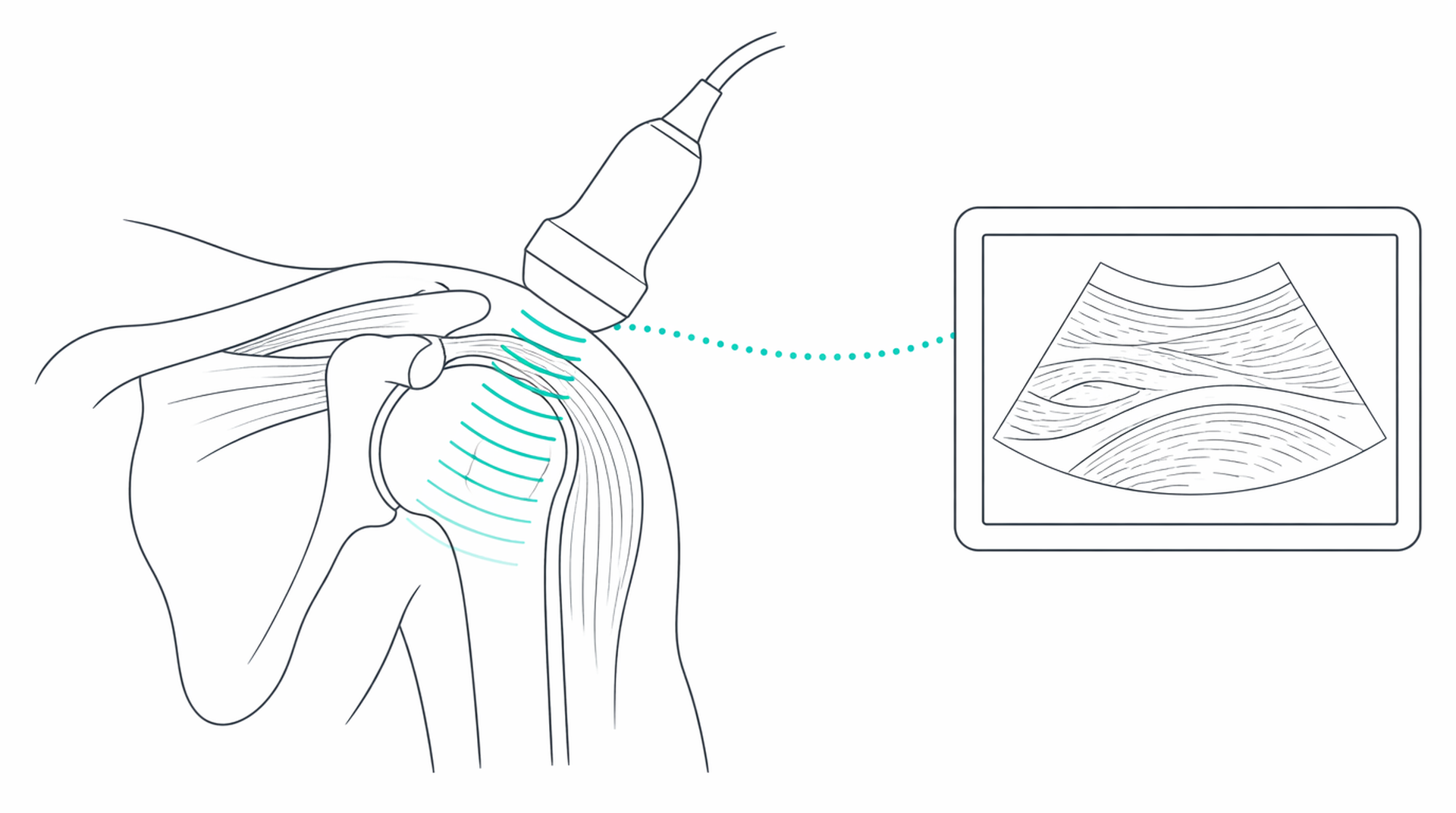 Medical line illustration of musculoskeletal ultrasound assessment for Joint aspiration.