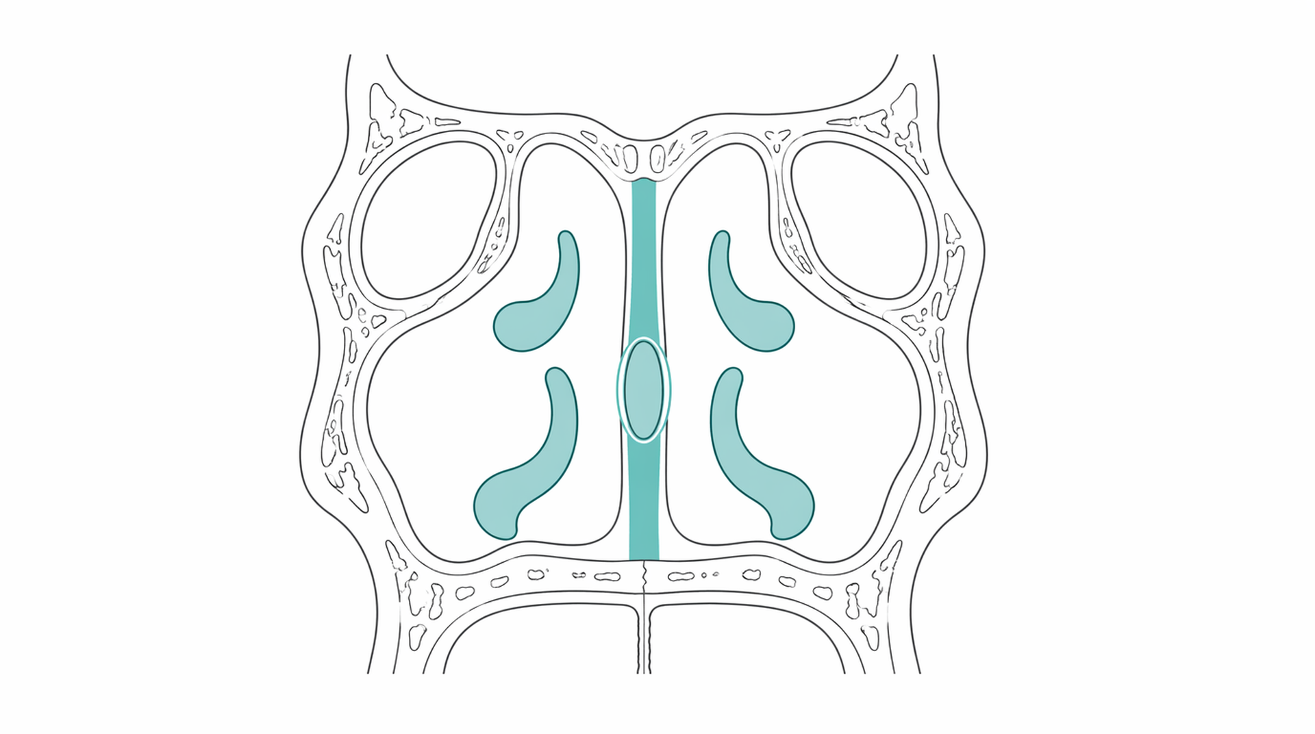 Medical line illustration of nasal septum turbinate airway for Septoplasty (deviated septum).