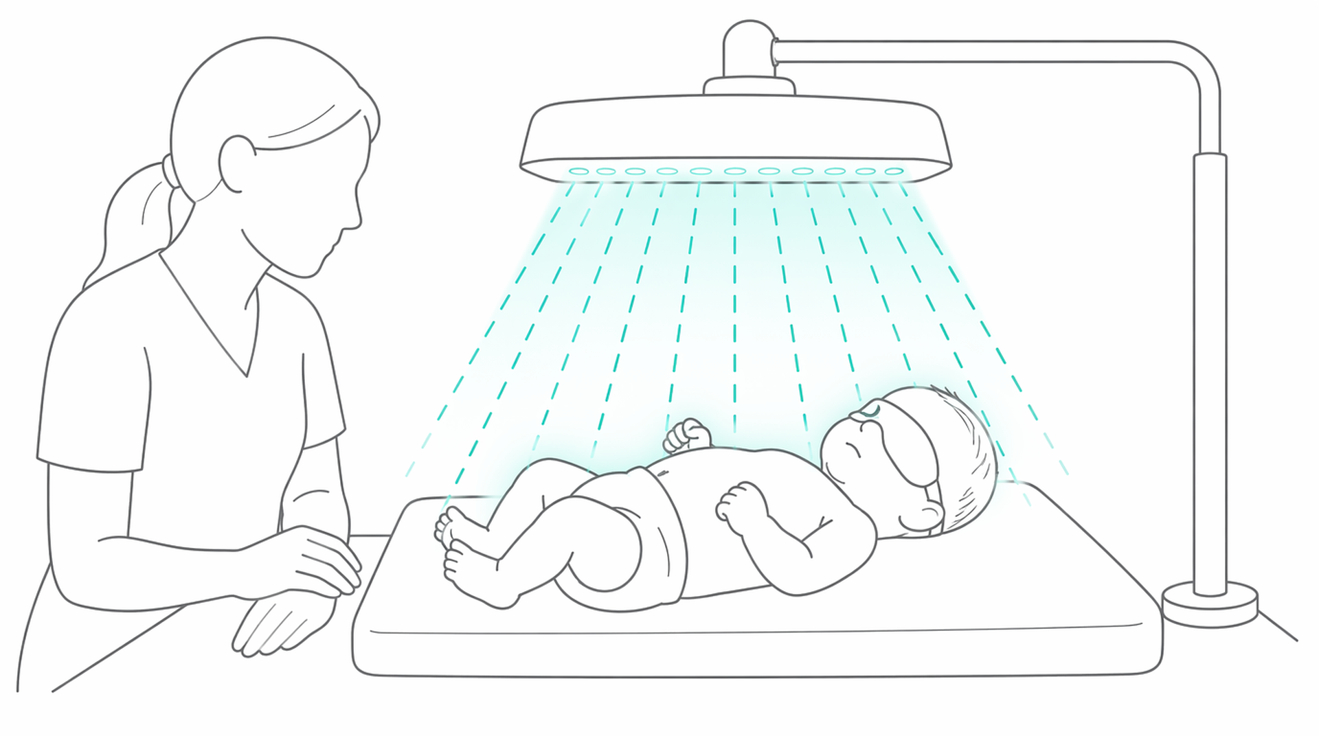 Medical line illustration of neonatal jaundice phototherapy for Jaundice in newborns.