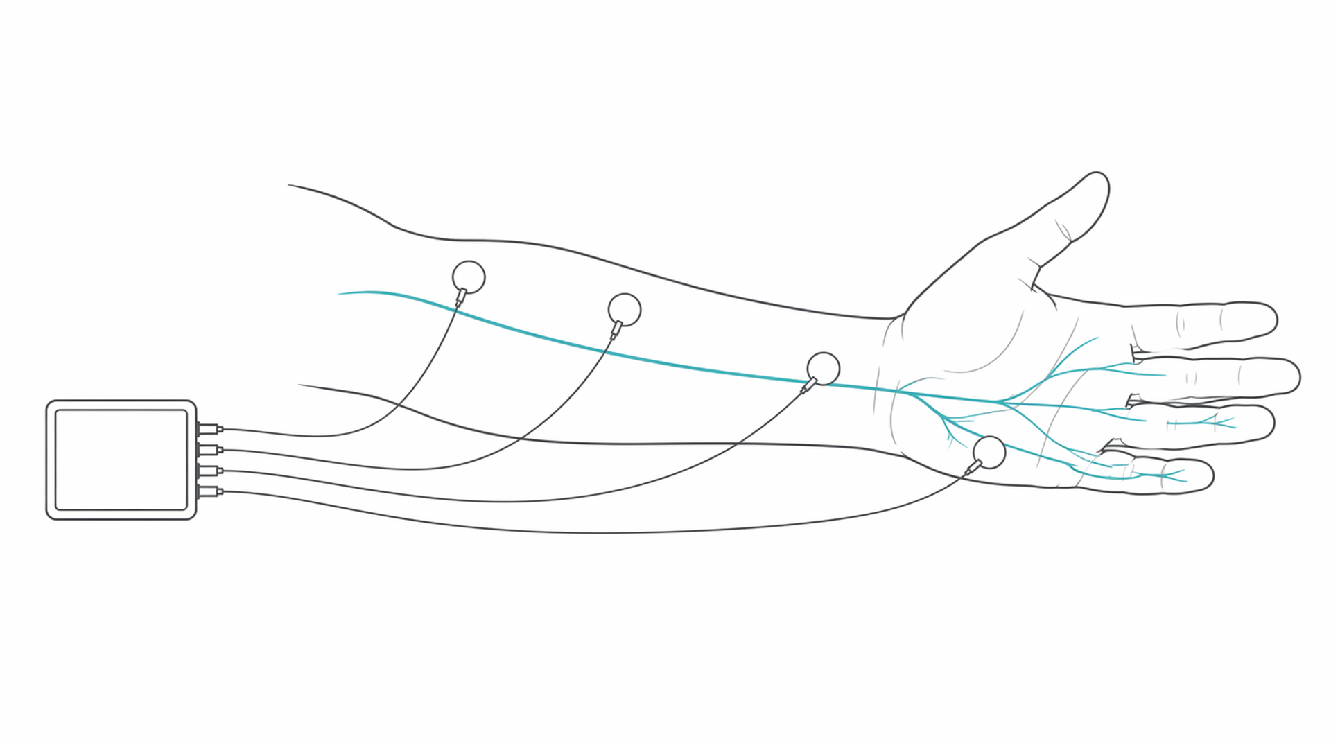 Medical line illustration of forearm electrodes and nerve conduction testing for EMG (muscle and nerve test).