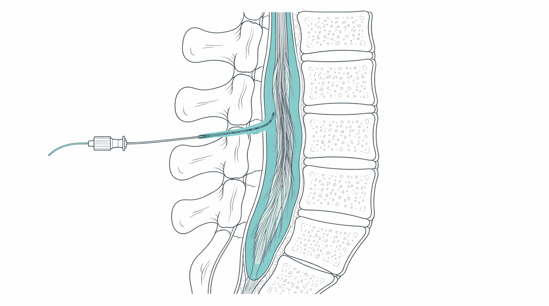 Medical line illustration of neuraxial anaesthesia spinal epidural for Spinal anaesthetic.