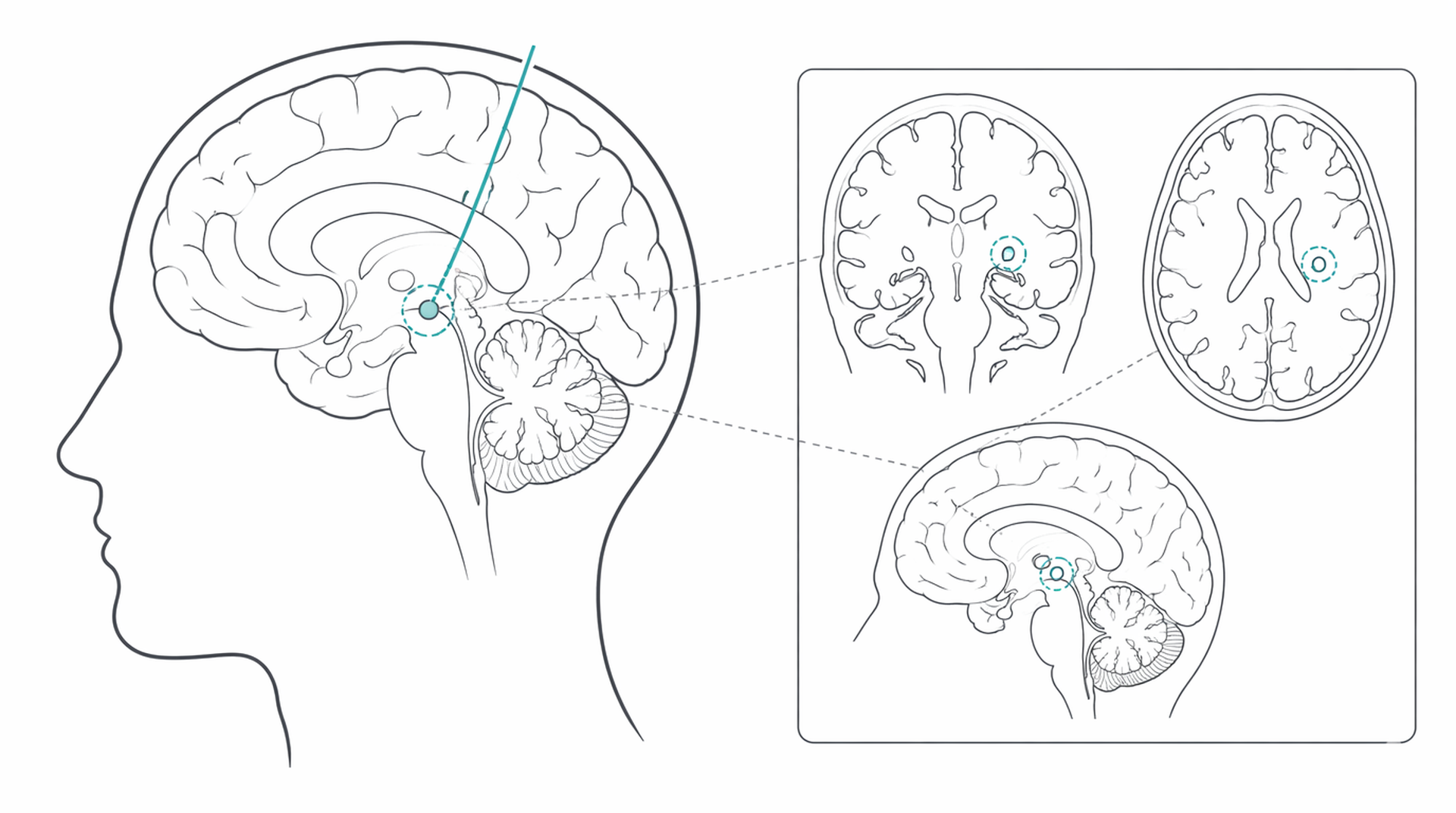 Medical line illustration of neurosurgery brain procedure for Craniotomy (brain surgery).
