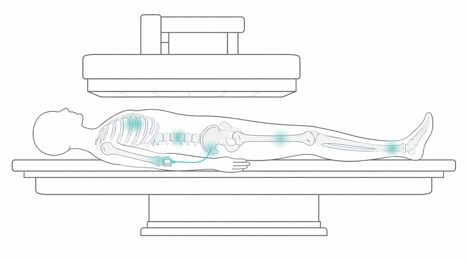 Medical line illustration of nuclear medicine gamma camera tracer scan for Bone scan.