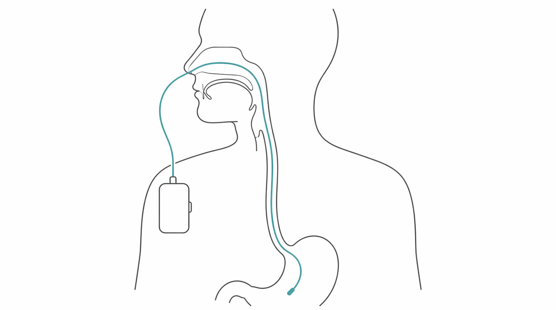 Medical line illustration of oesophageal manometry ph monitoring for Heller's myotomy (achalasia surgery).
