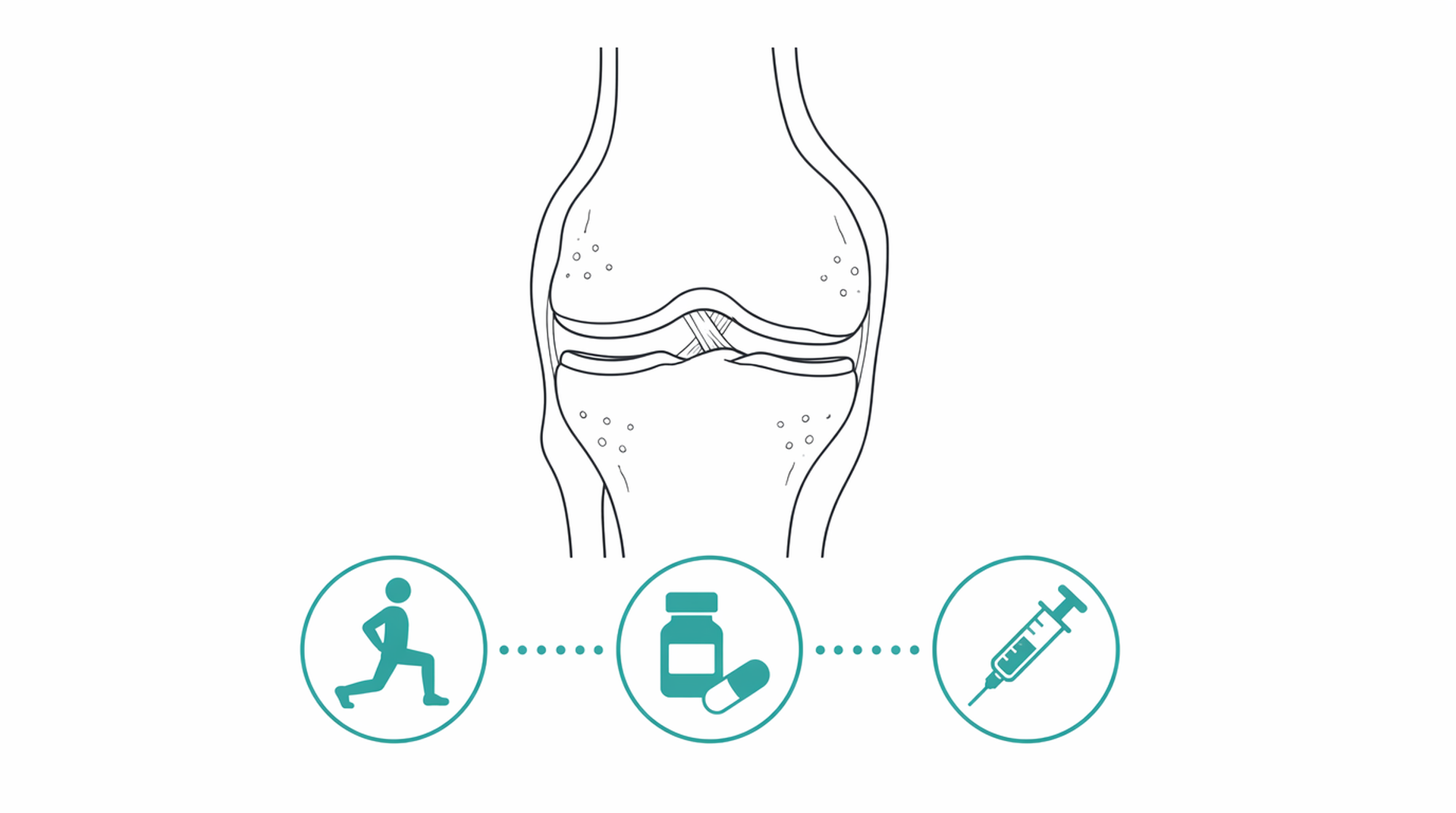 Medical line illustration of osteoarthritis joint review for Prolotherapy.