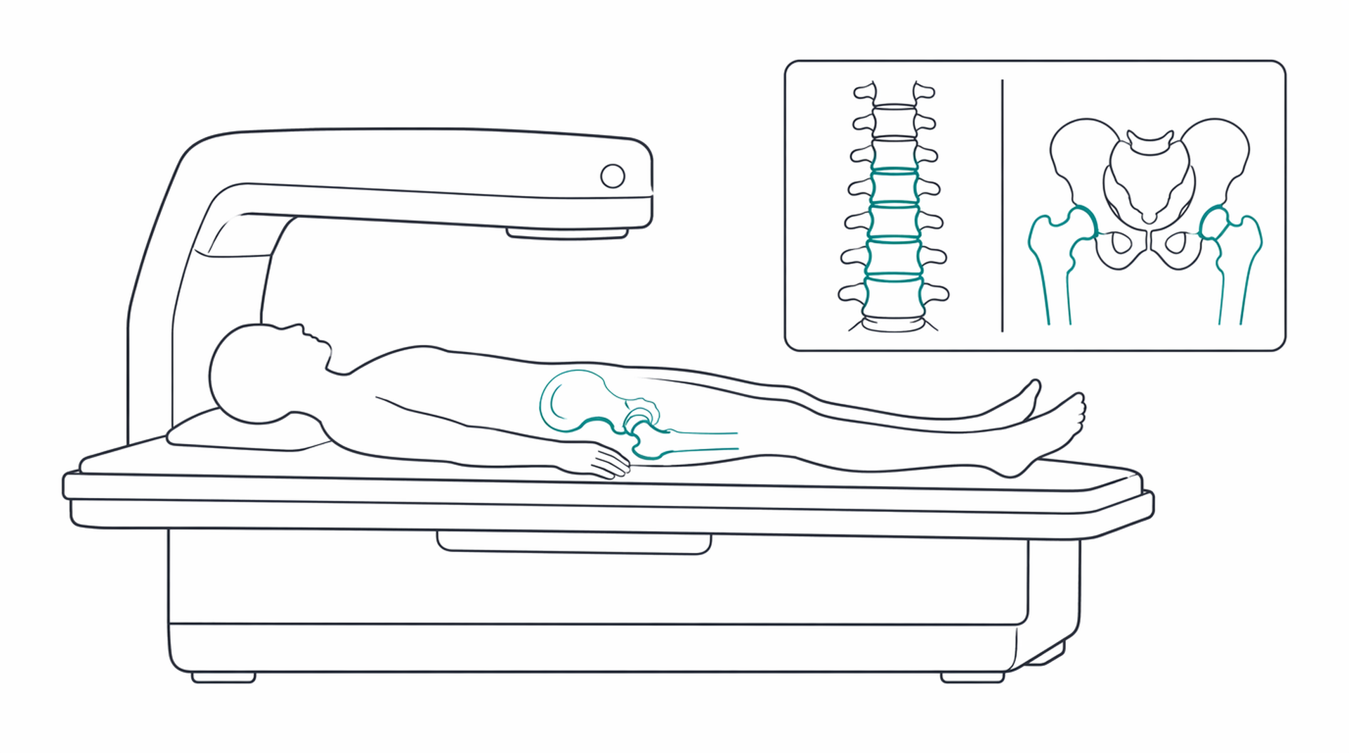 Medical line illustration of osteoporosis dexa scan for DEXA bone density scan.