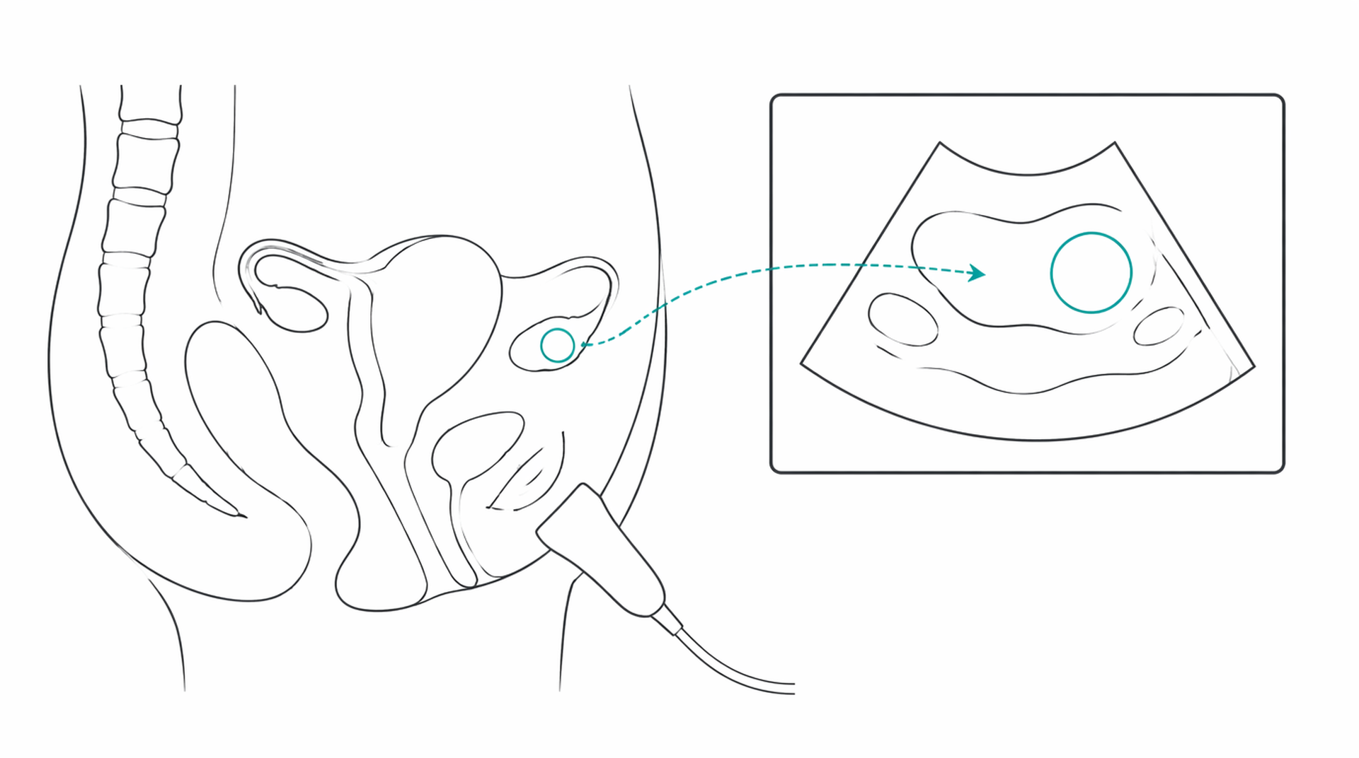 Medical line illustration of ovarian cyst gynaecology for Ovarian cyst removal.