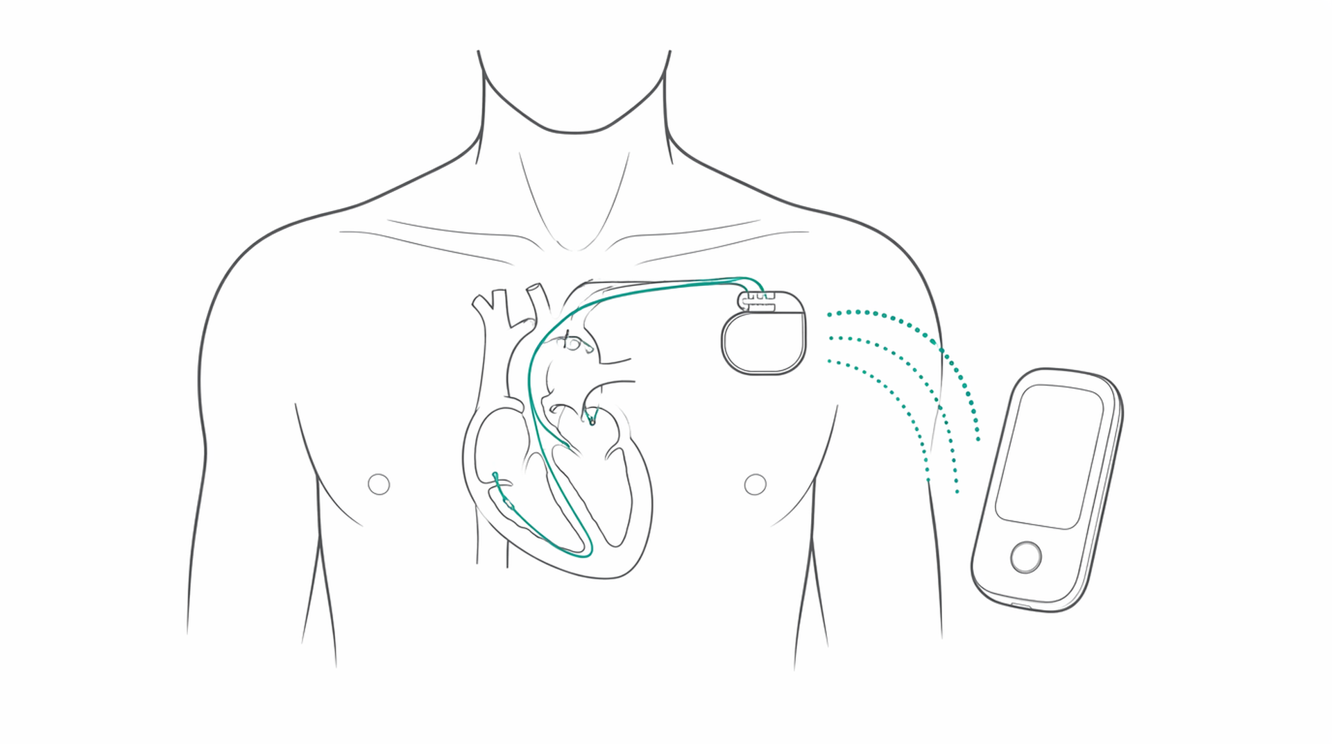 Medical line illustration of pacemaker cardiac device for Pacemaker fitting.
