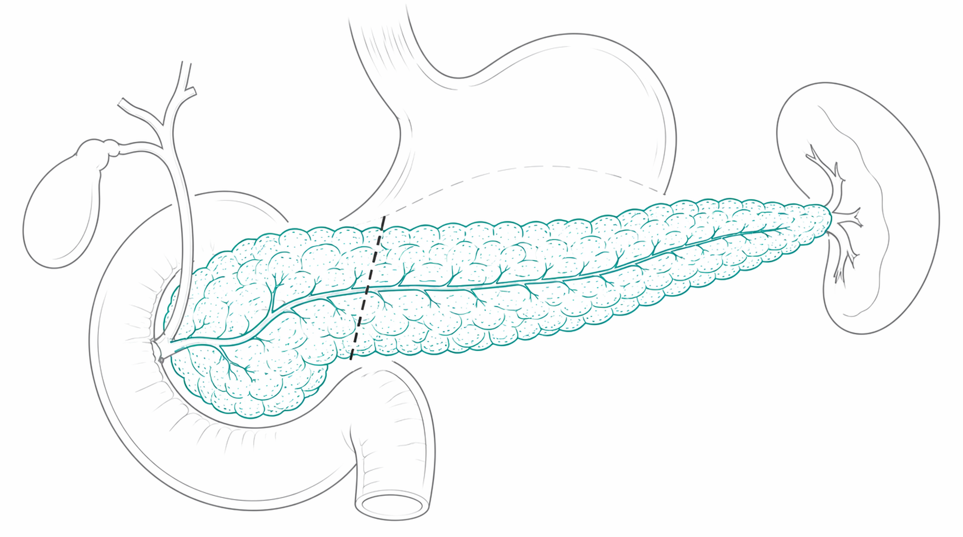 Medical line illustration of pancreas anatomy and resection for Distal pancreatectomy.