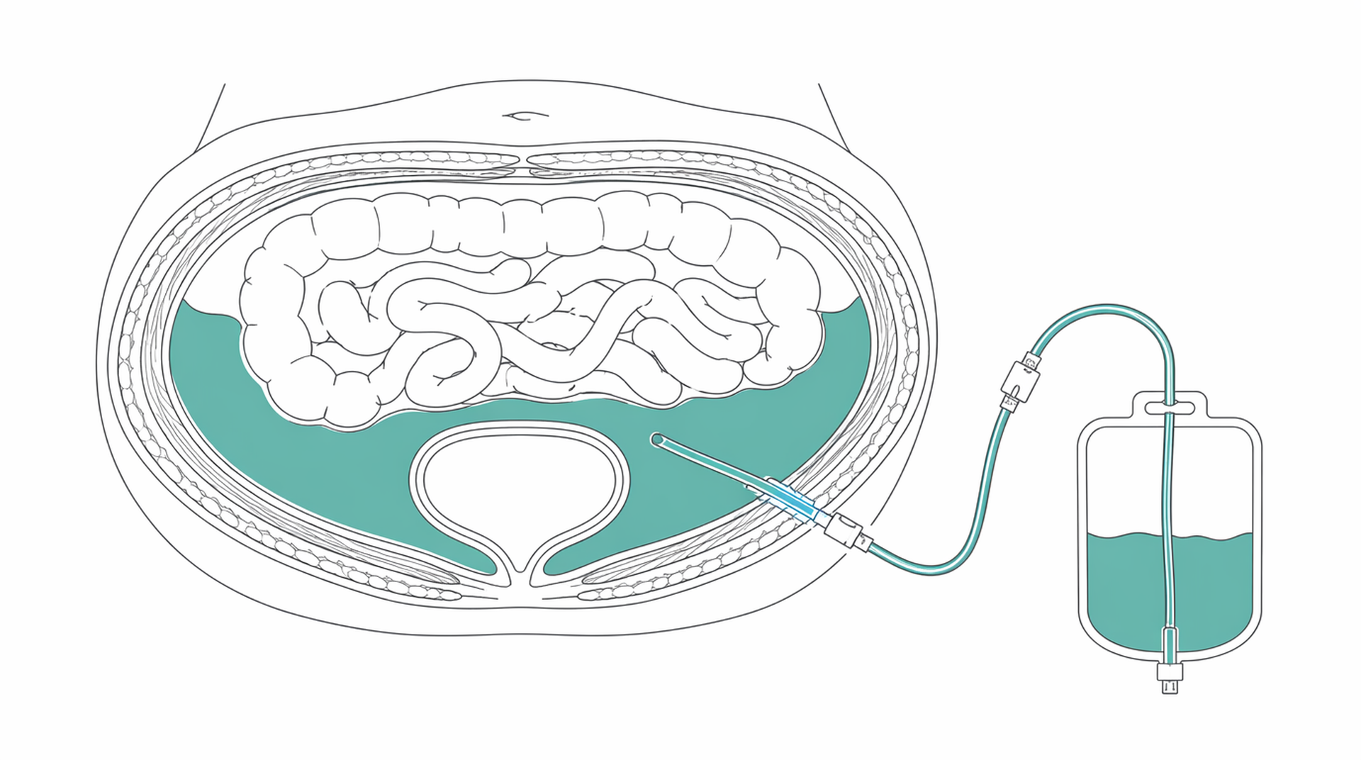 Medical line illustration of paracentesis ascites drainage for Ascites drainage (paracentesis).
